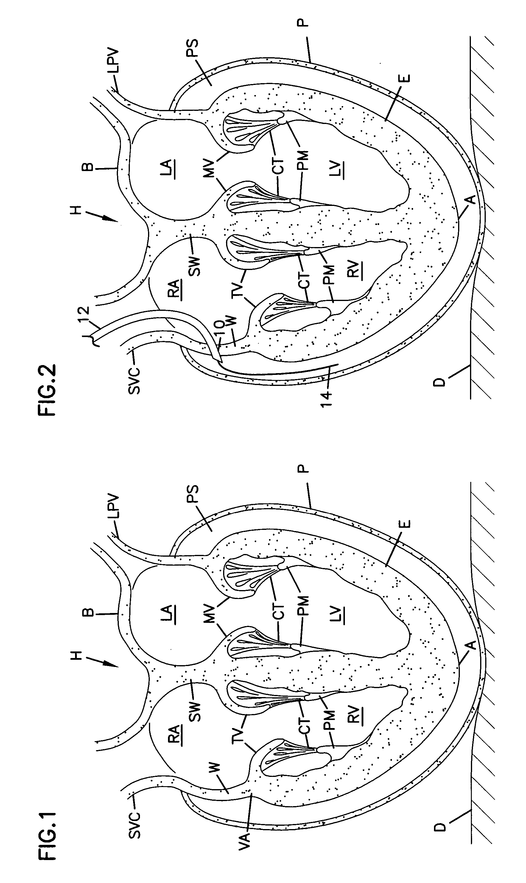 Transmyocardial delivery of cardiac wall tension relief