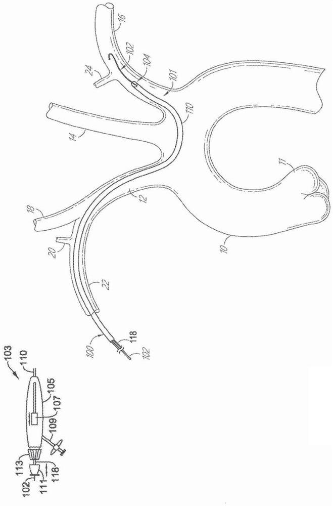 Systems for protecting the cerebral vasculature