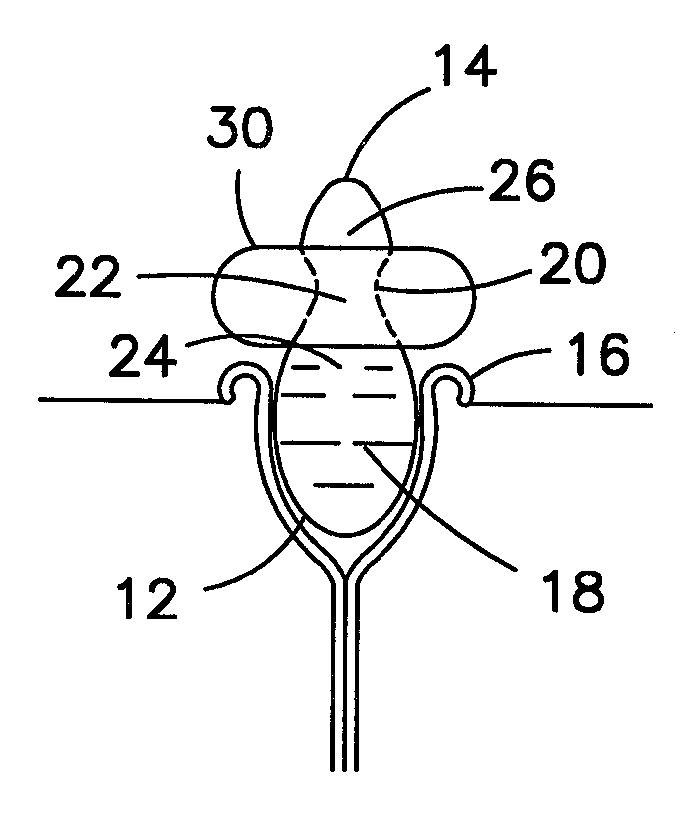 Stoma plug