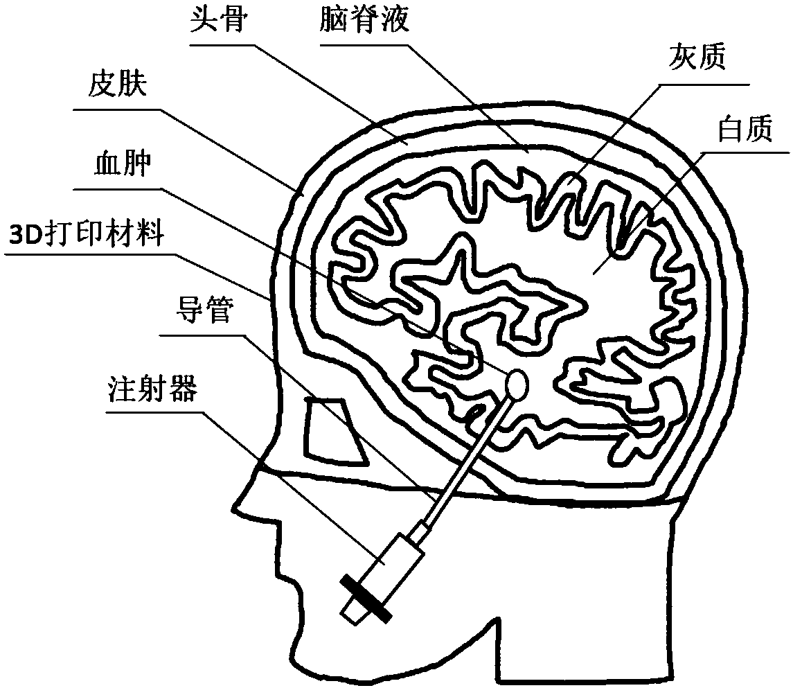 Method for making cerebral hematoma model with multi-layer heterogeneous structure