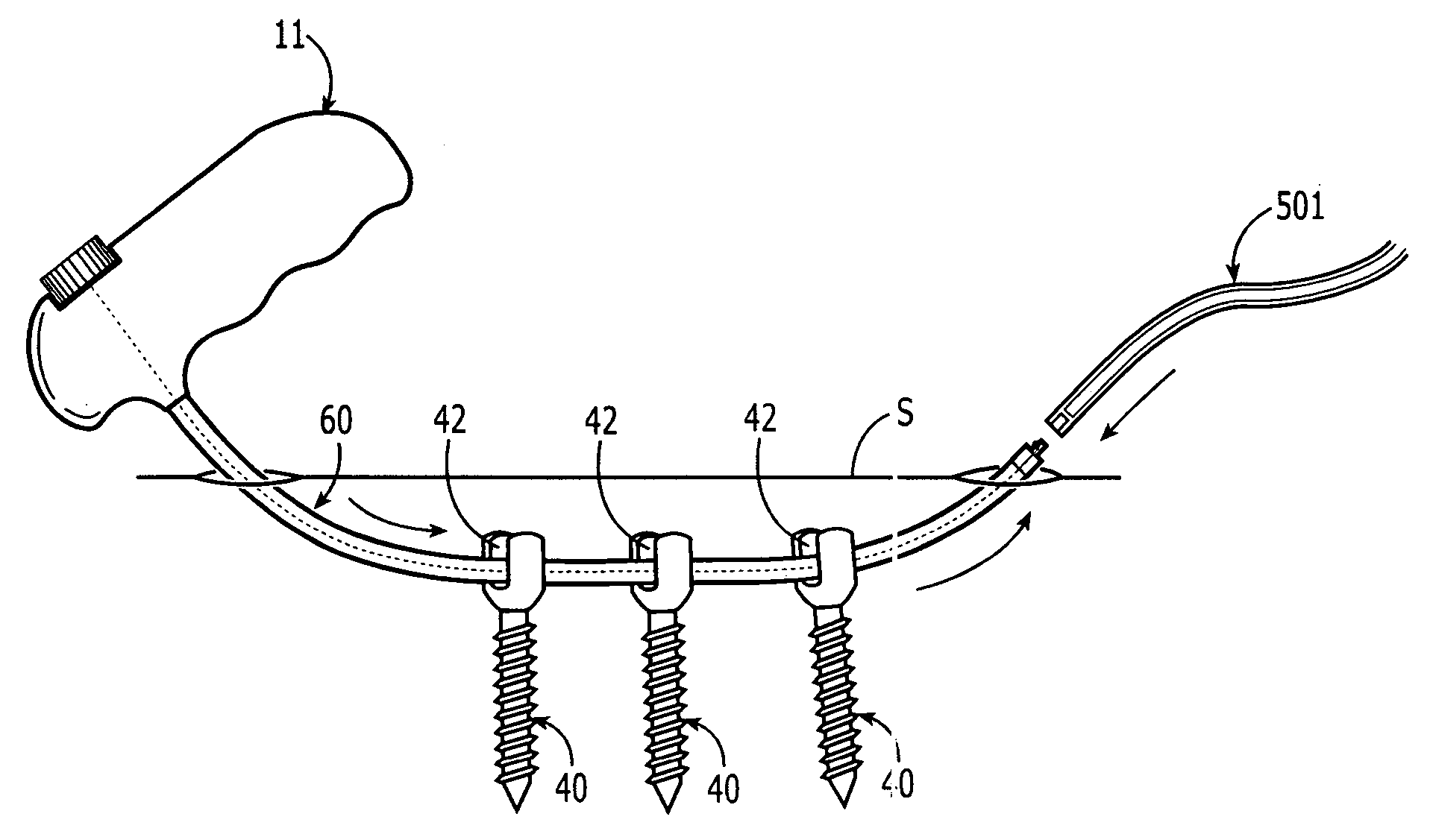 Rod delivery device and method