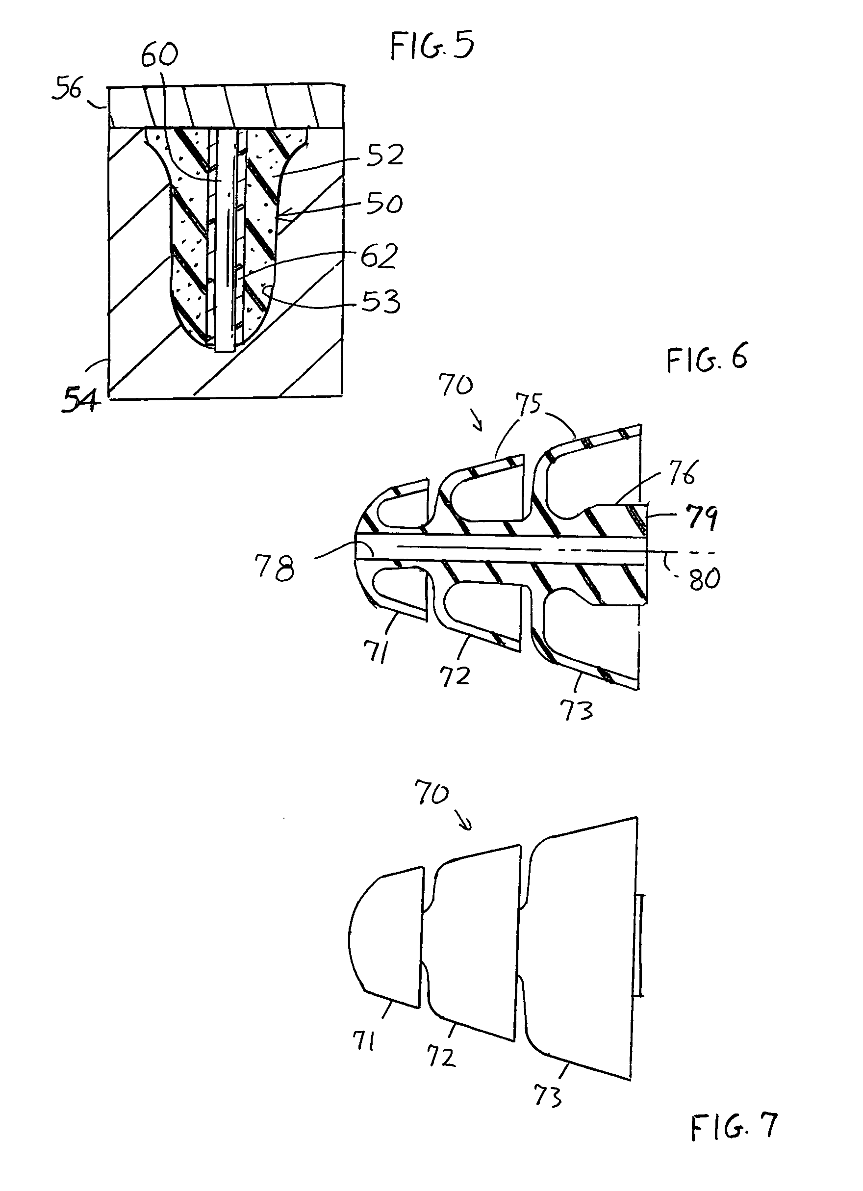 Method of forming an in-ear device