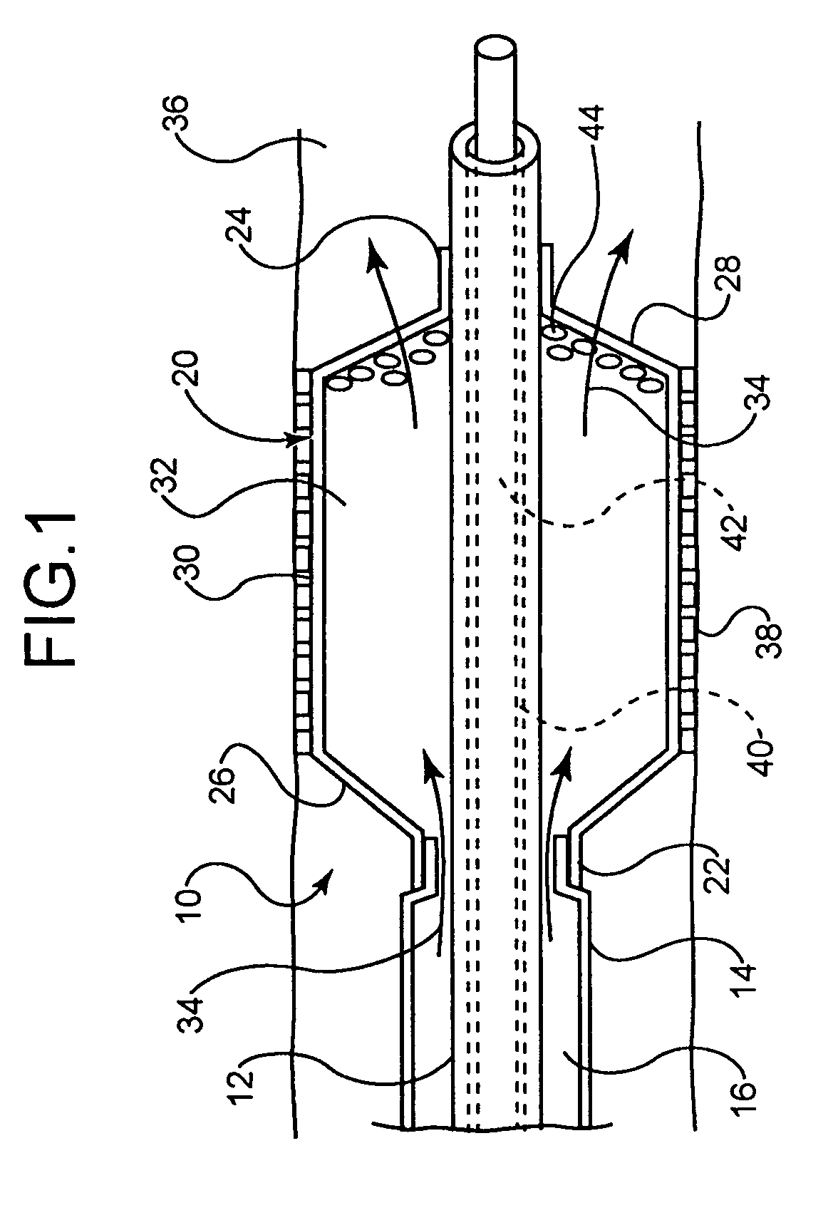 Intravascular dilatation infusion catheter