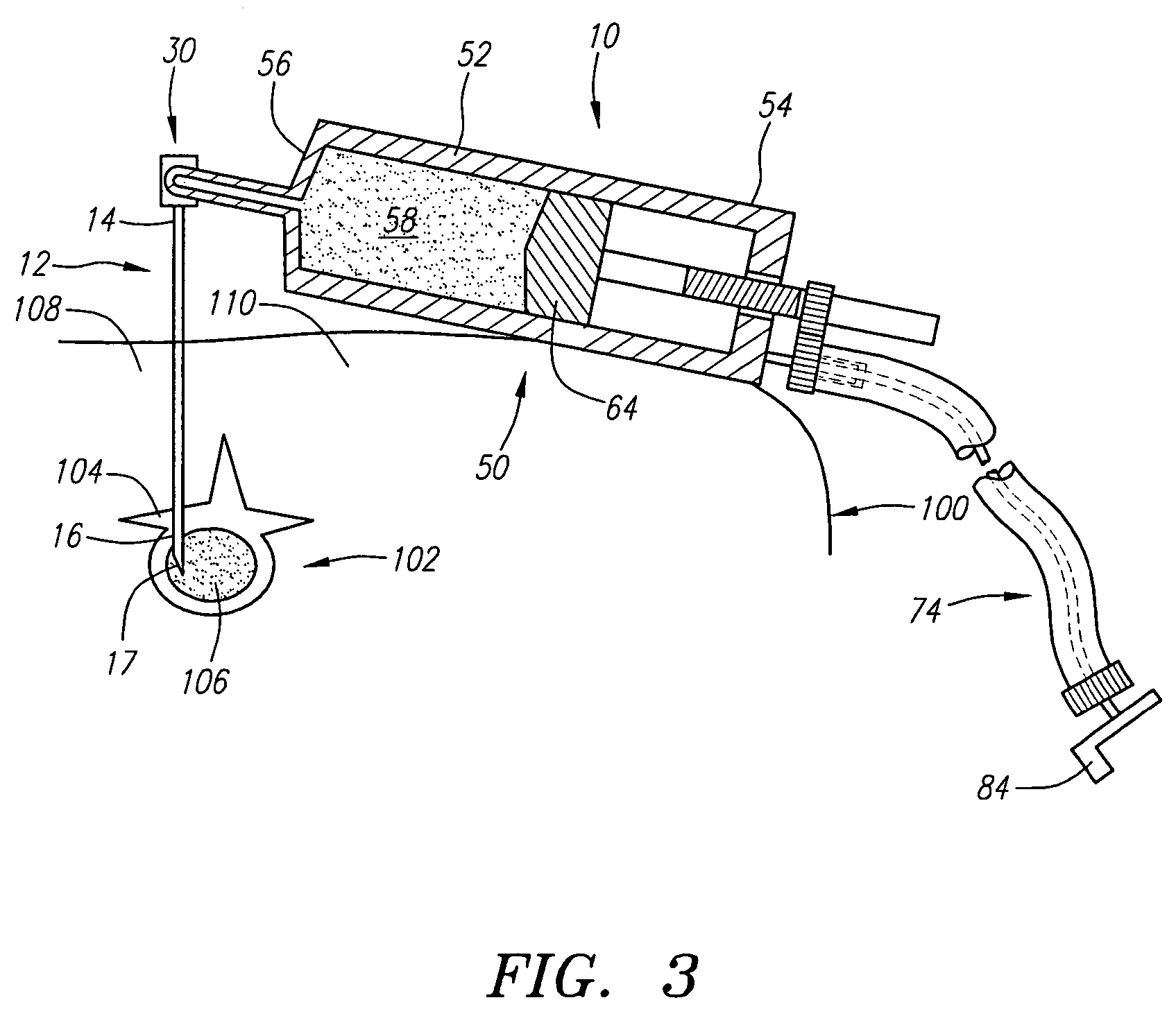 Apparatus and methods for delivering compounds into vertebrae for vertebroplasty