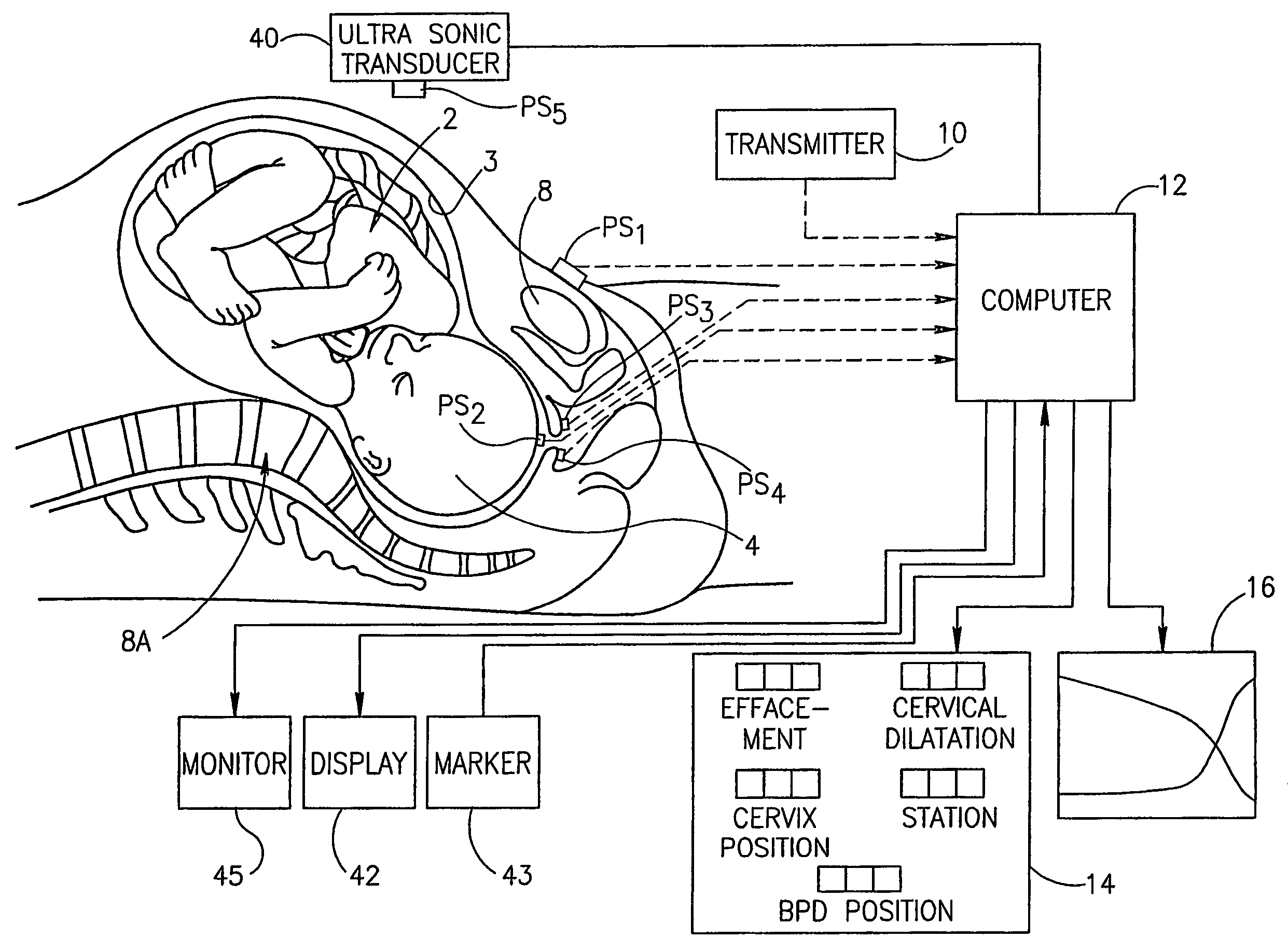 Method and apparatus for monitoring the progress of labor