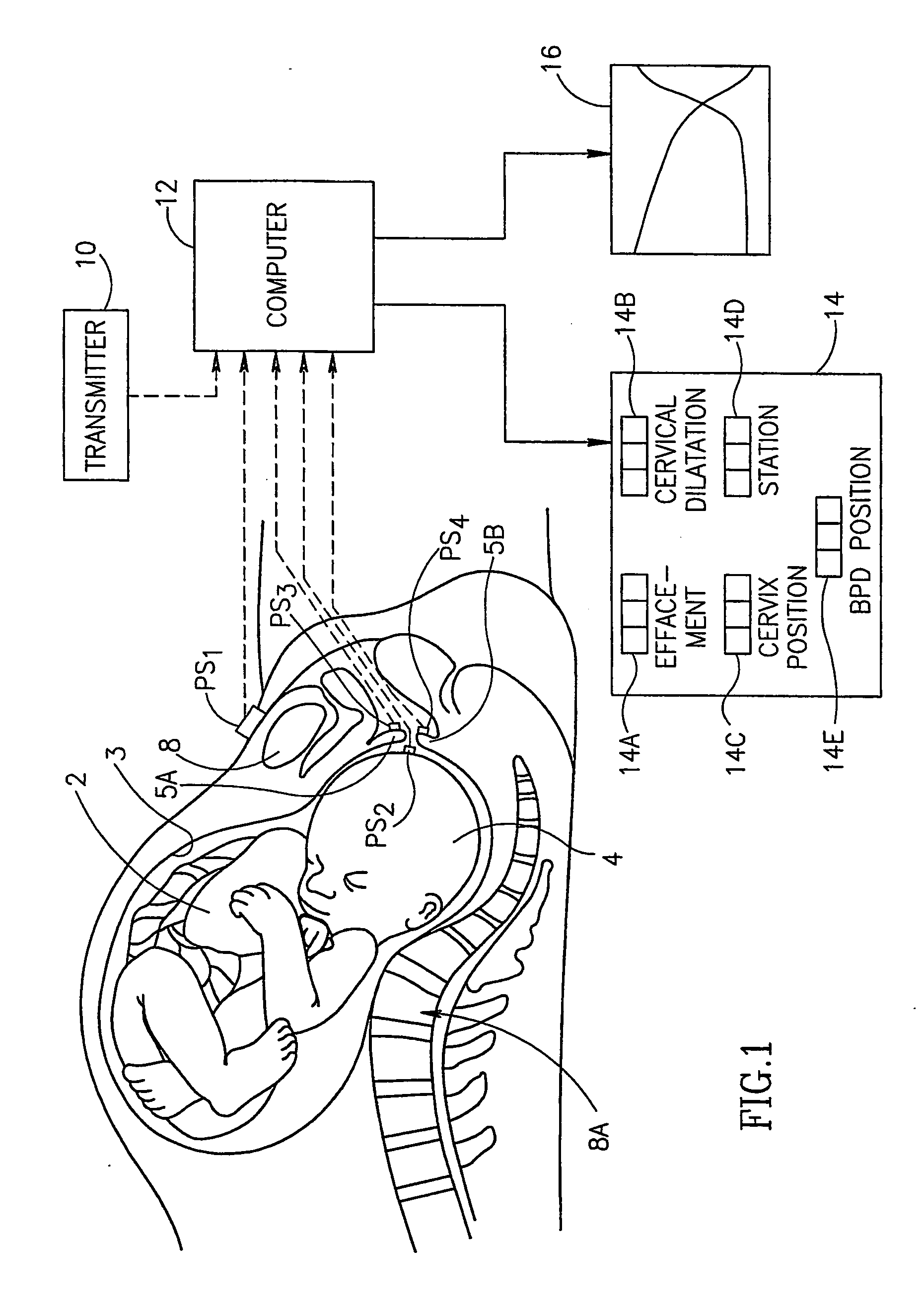 Method and apparatus for monitoring the progress of labor