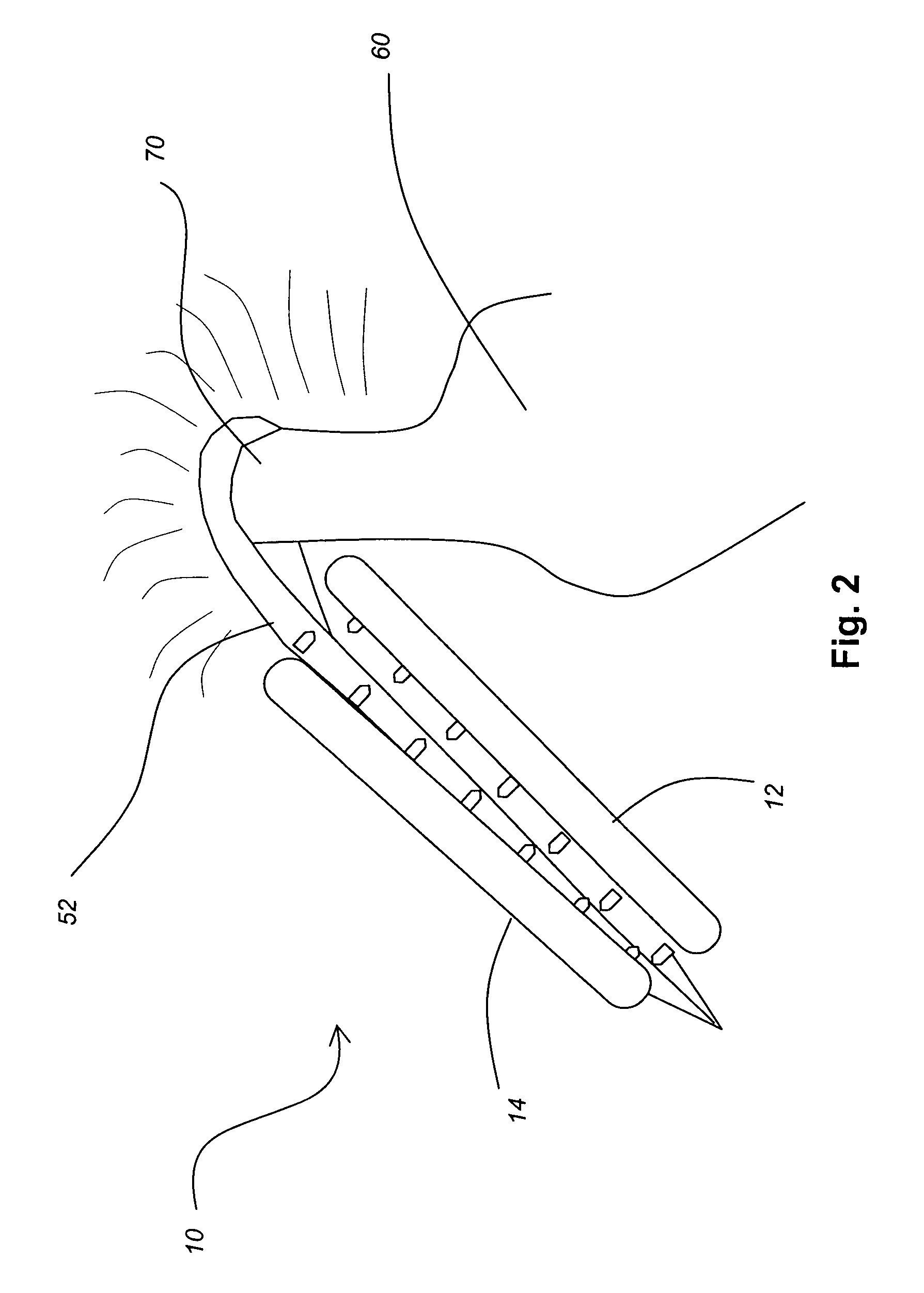 Systems and methods for valve annulus remodeling