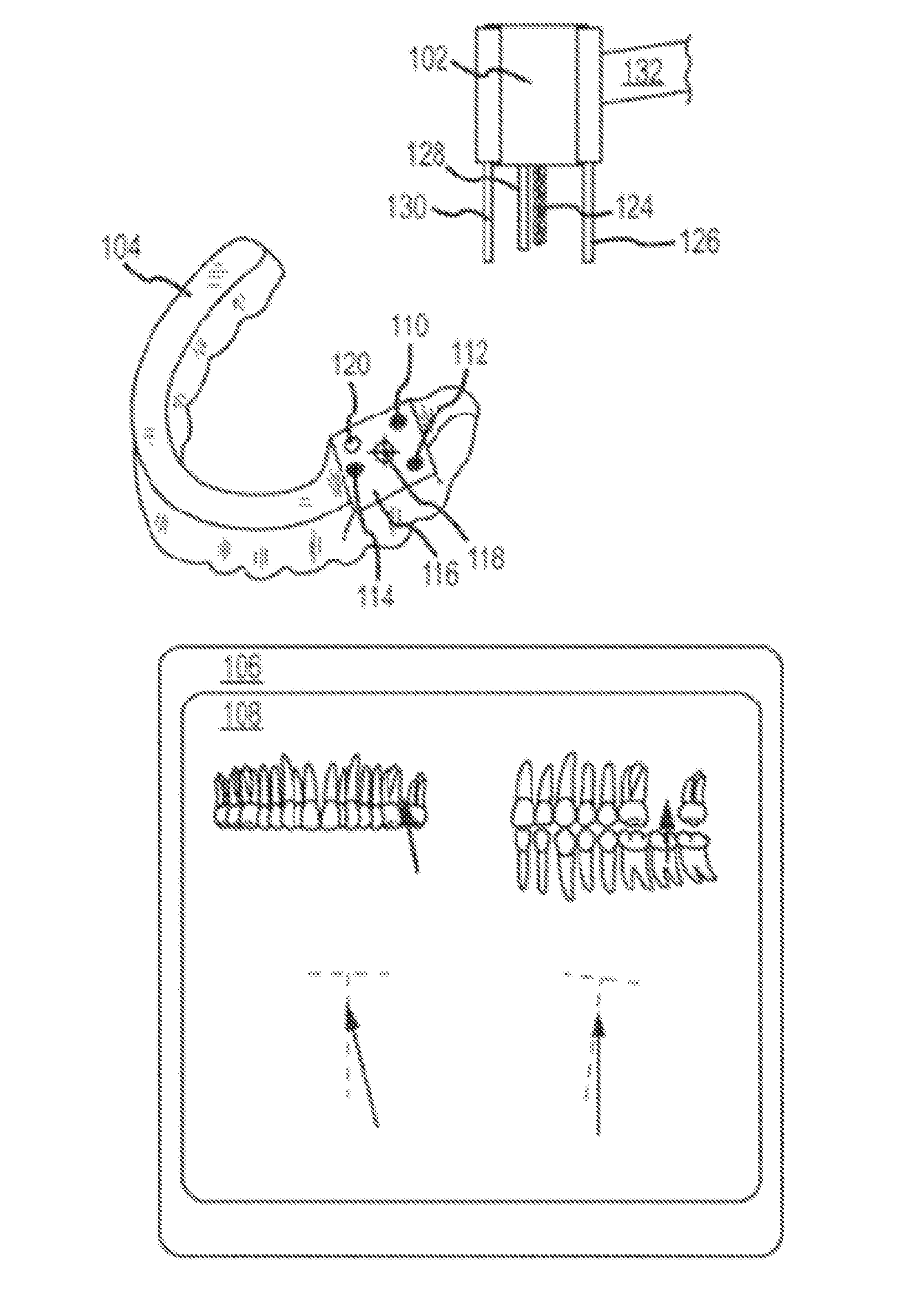 Dental implantation system and method