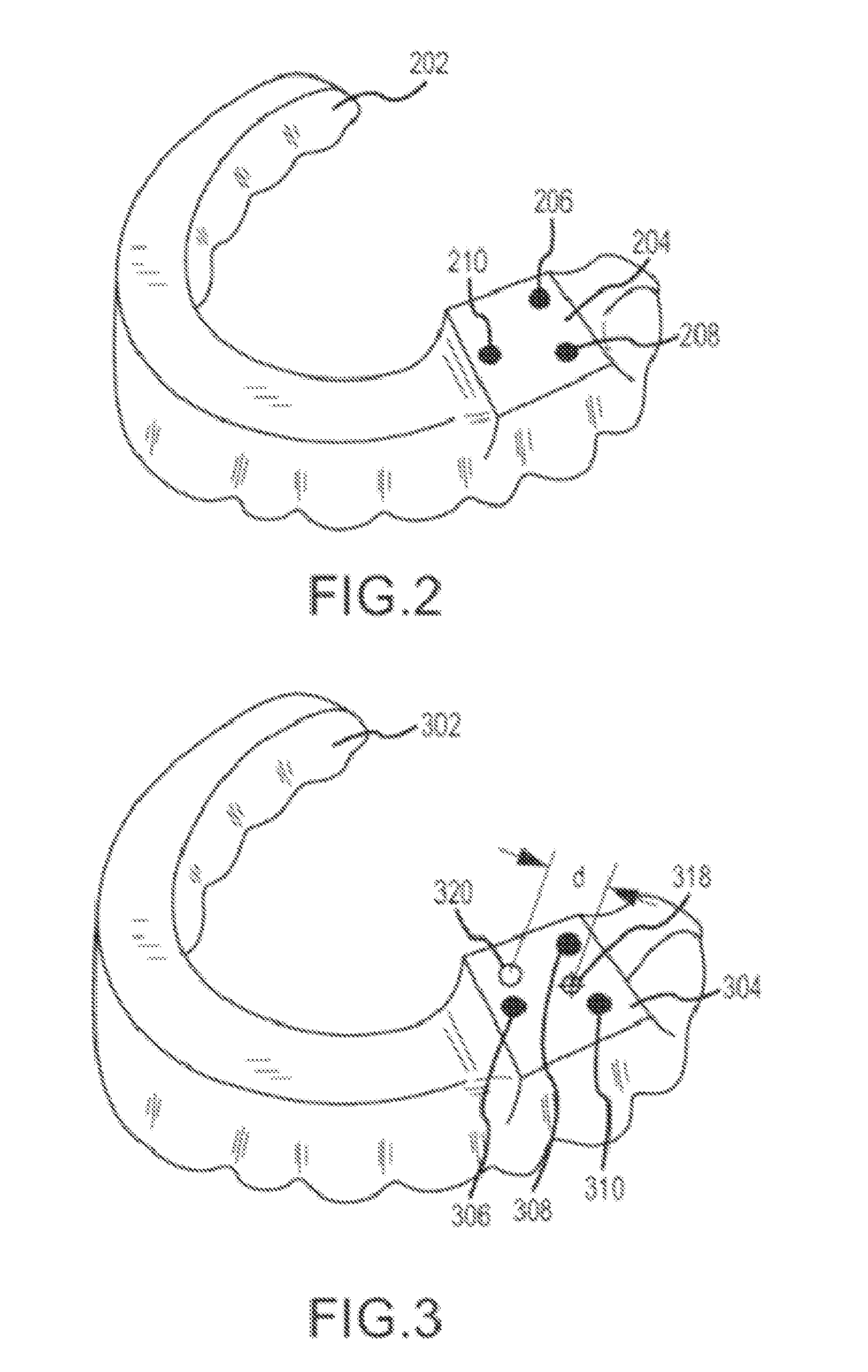 Dental implantation system and method