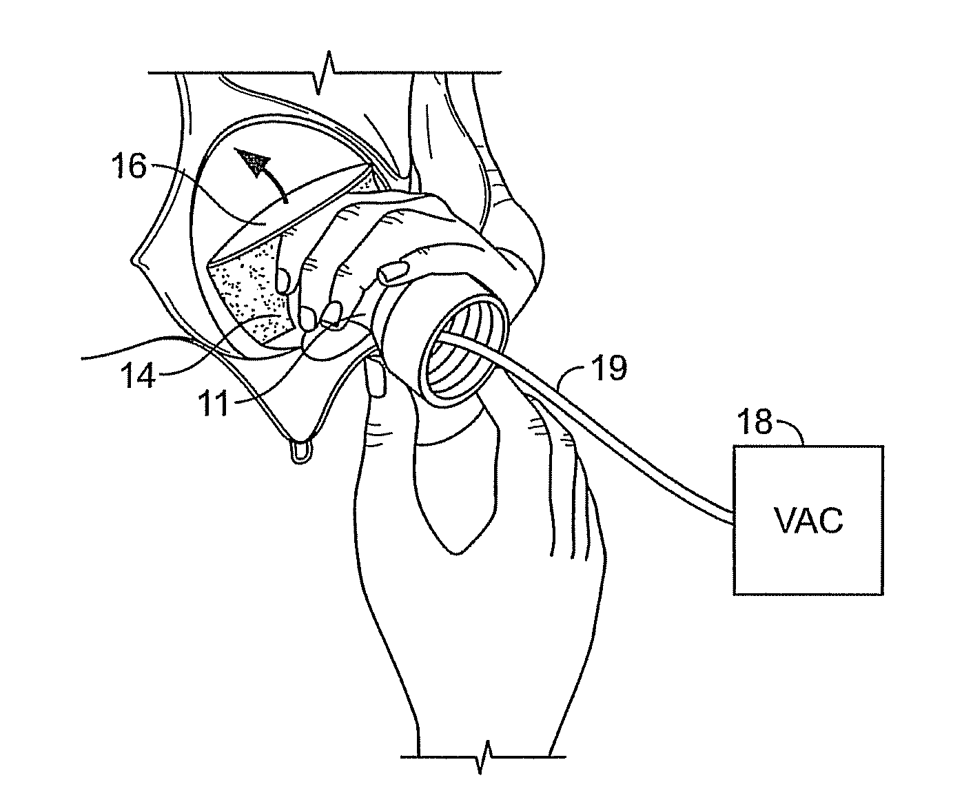 Adhesively Supporting a Breastshield