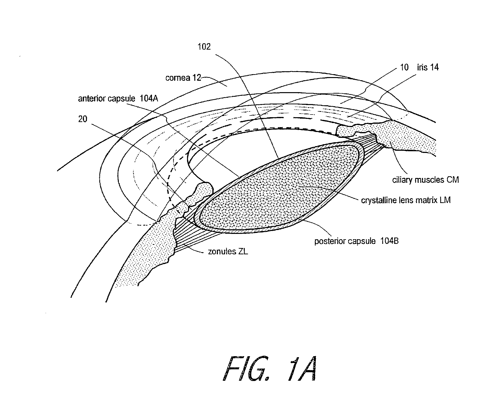 Accommodating Intraocular Lens