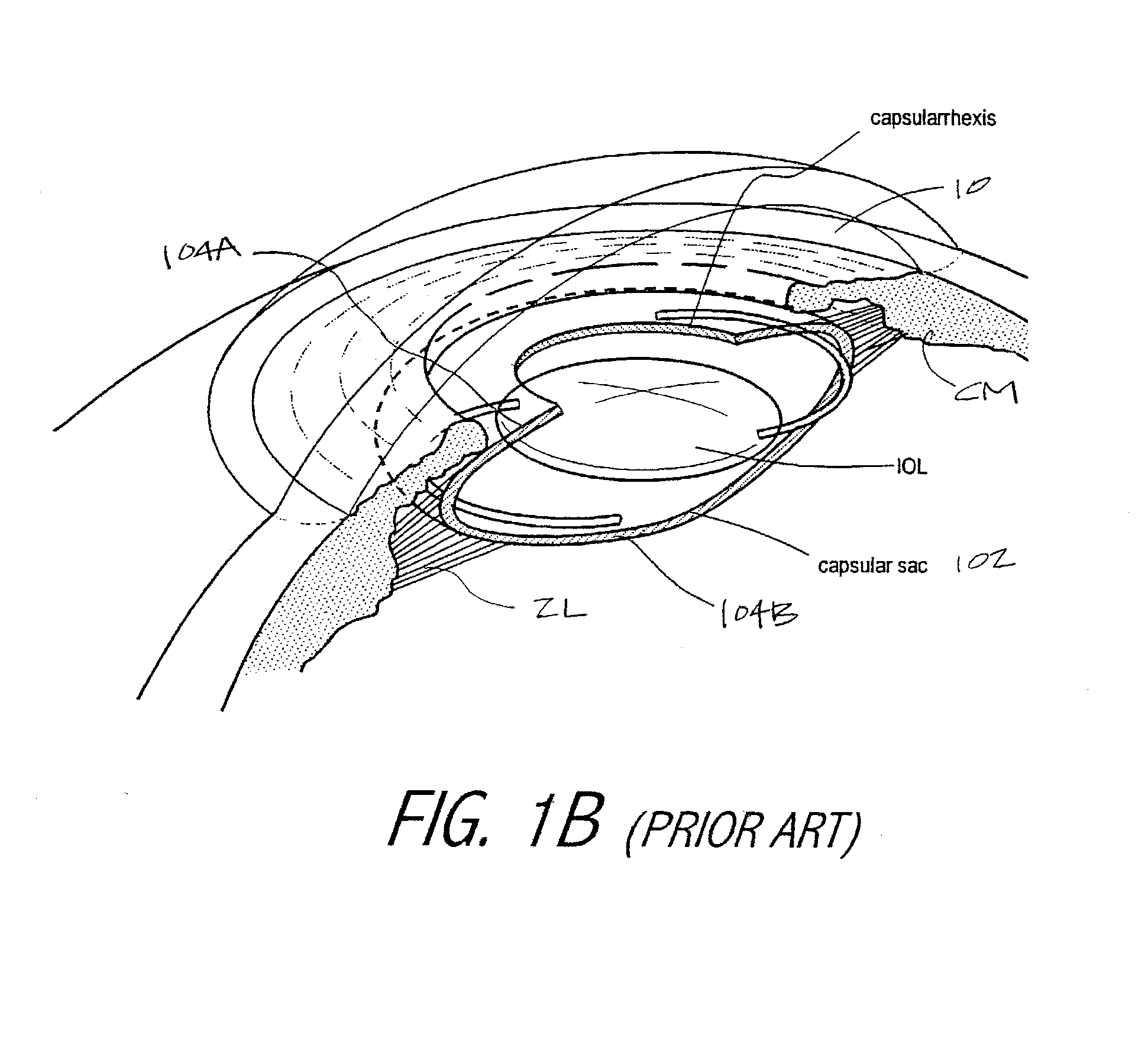 Accommodating Intraocular Lens