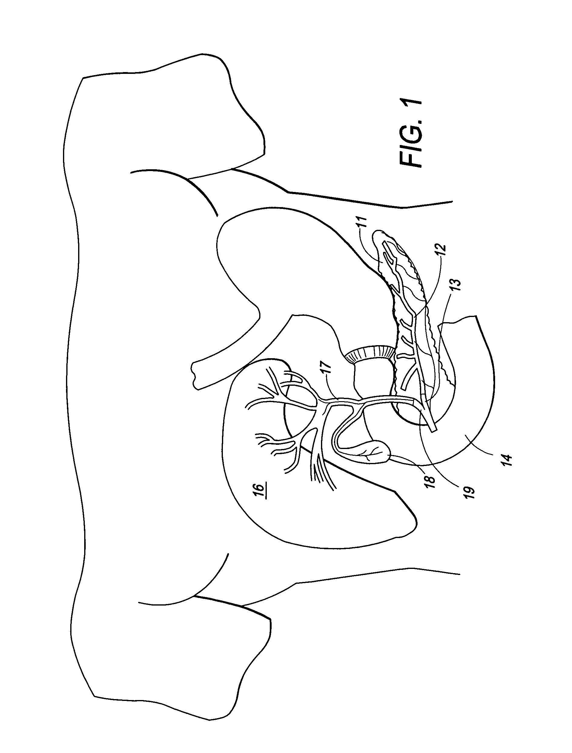 Method and apparatus for electrical stimulation of the pancreatico-biliary system