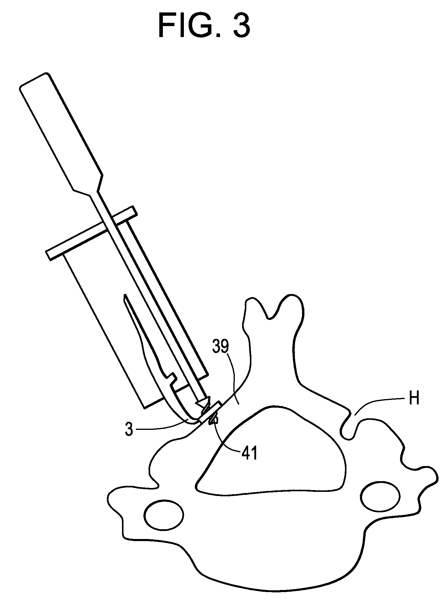 Methods and Devices for Expanding A Spinal Canal Using Balloons