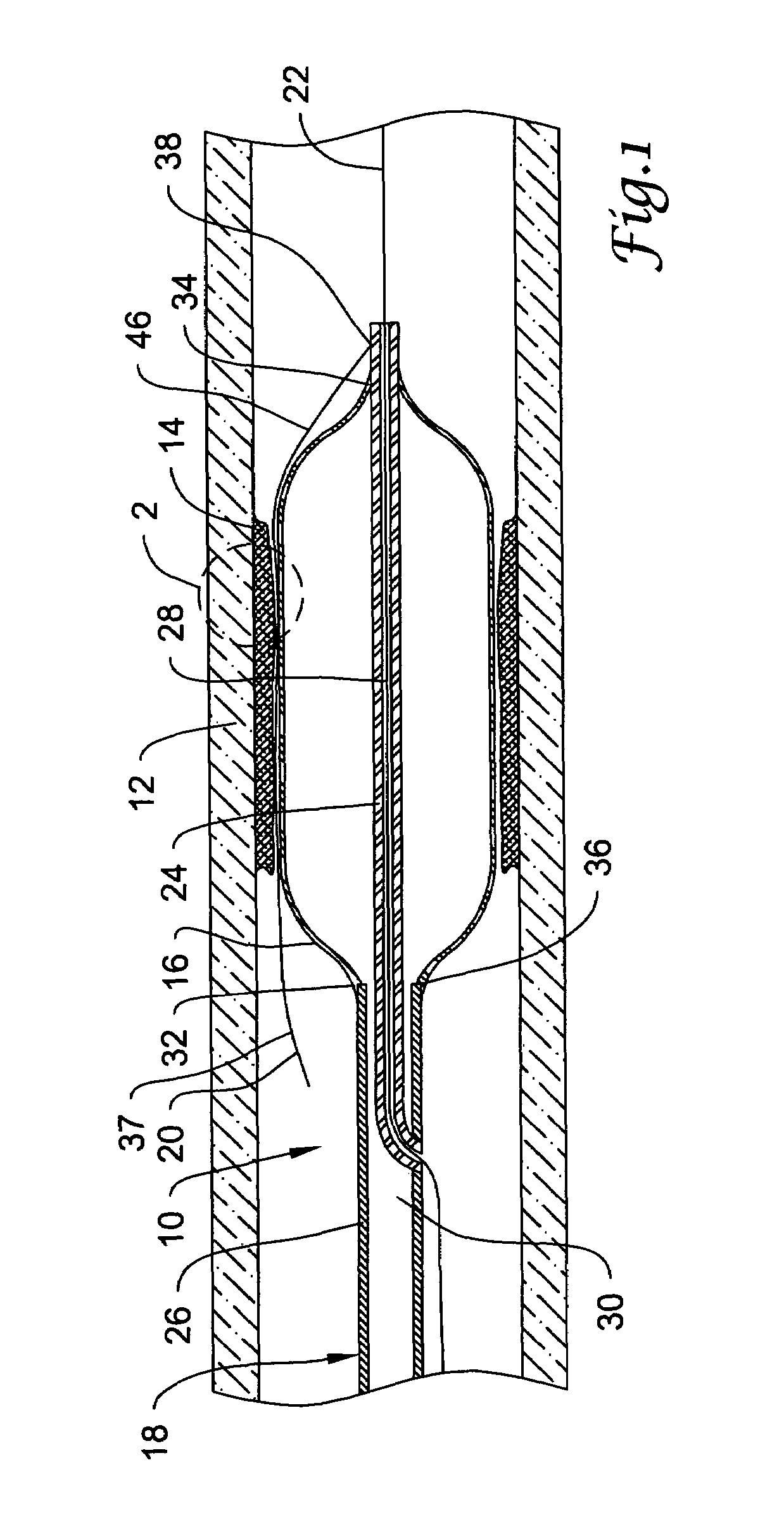 Traction balloon