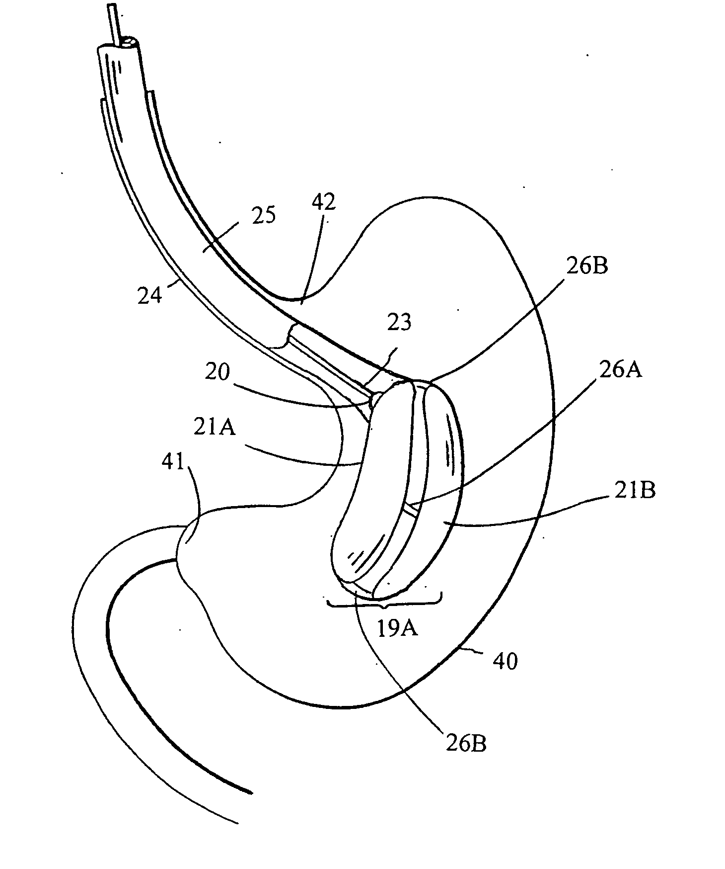 Intragastric space filler