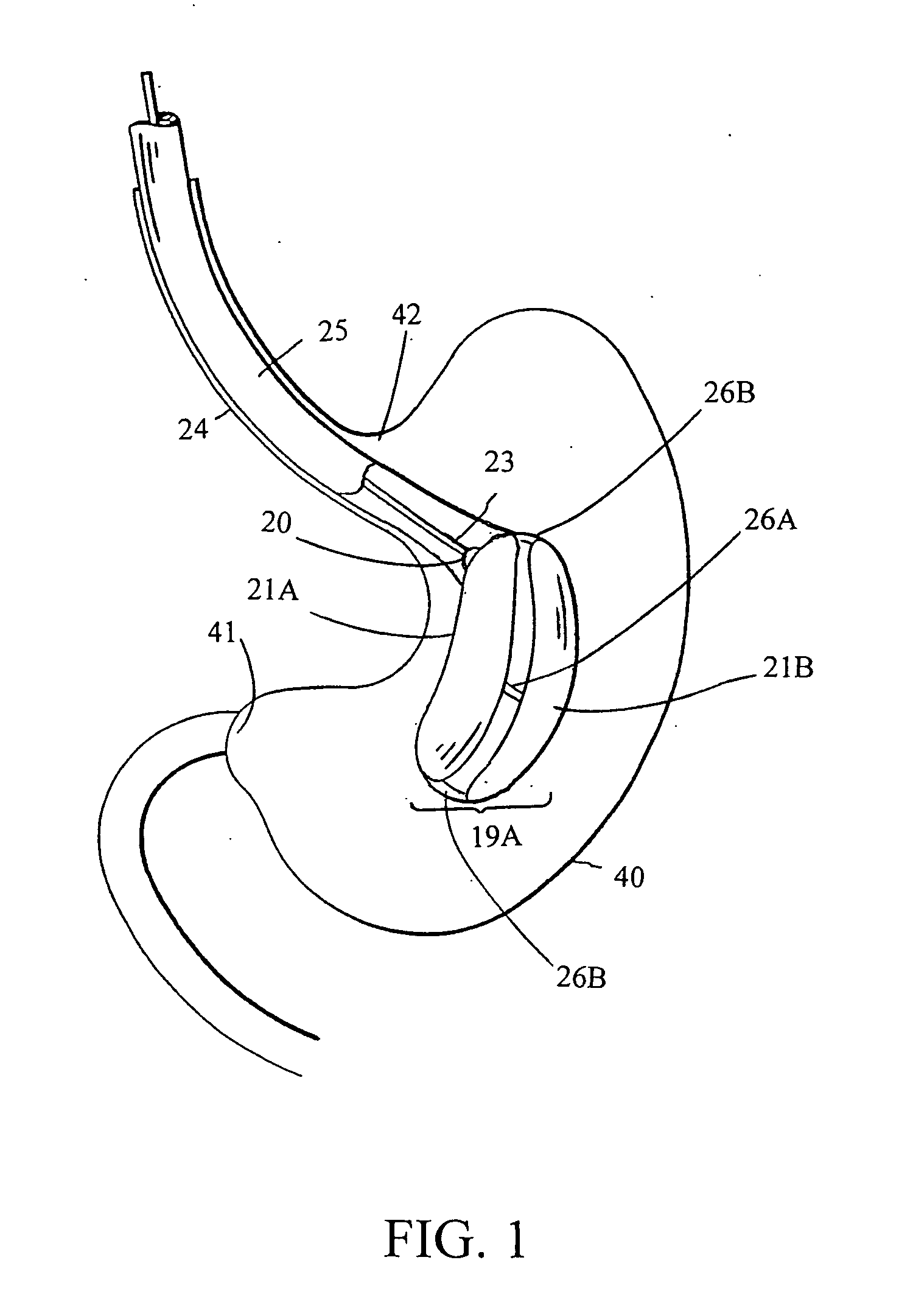 Intragastric space filler