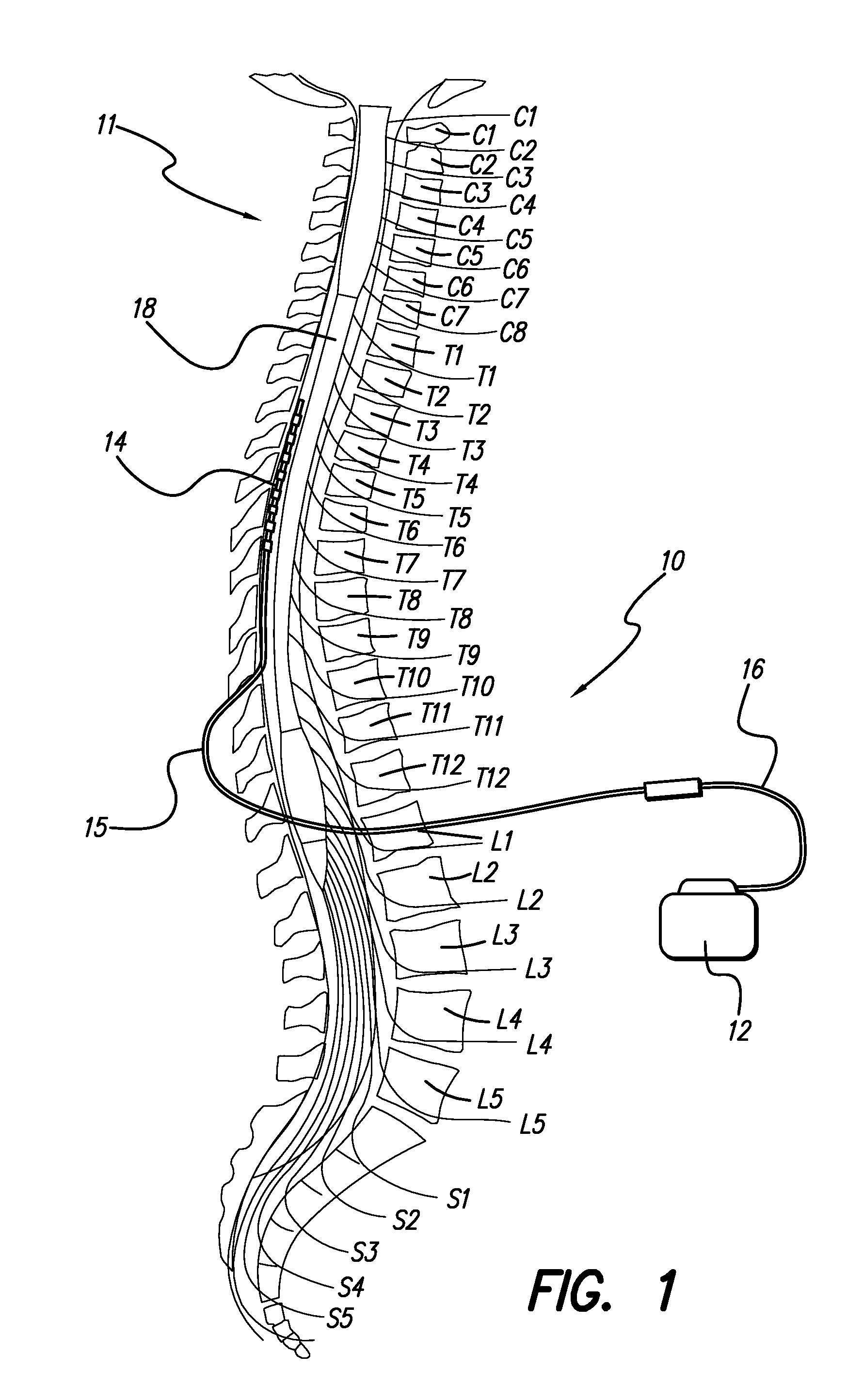 Neural stimulation lead fixation