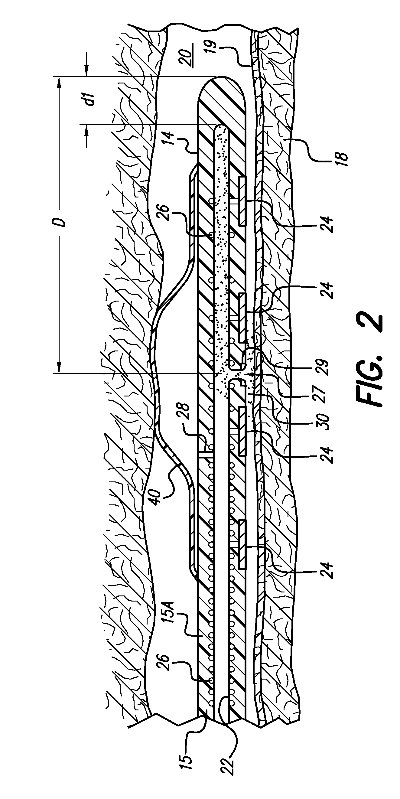 Neural stimulation lead fixation