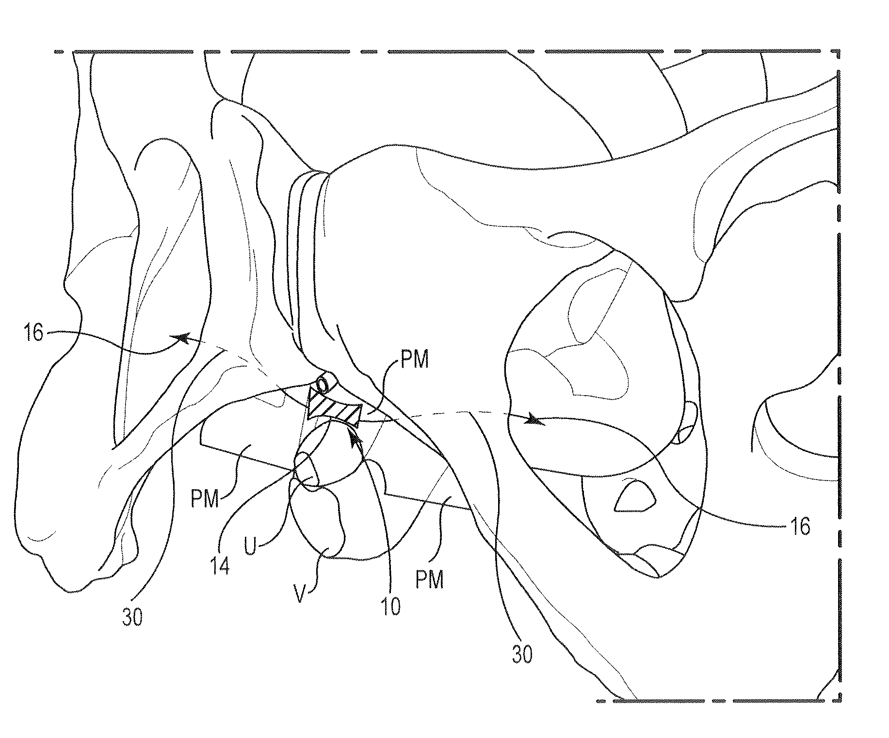 Pelvic Implant System and Method