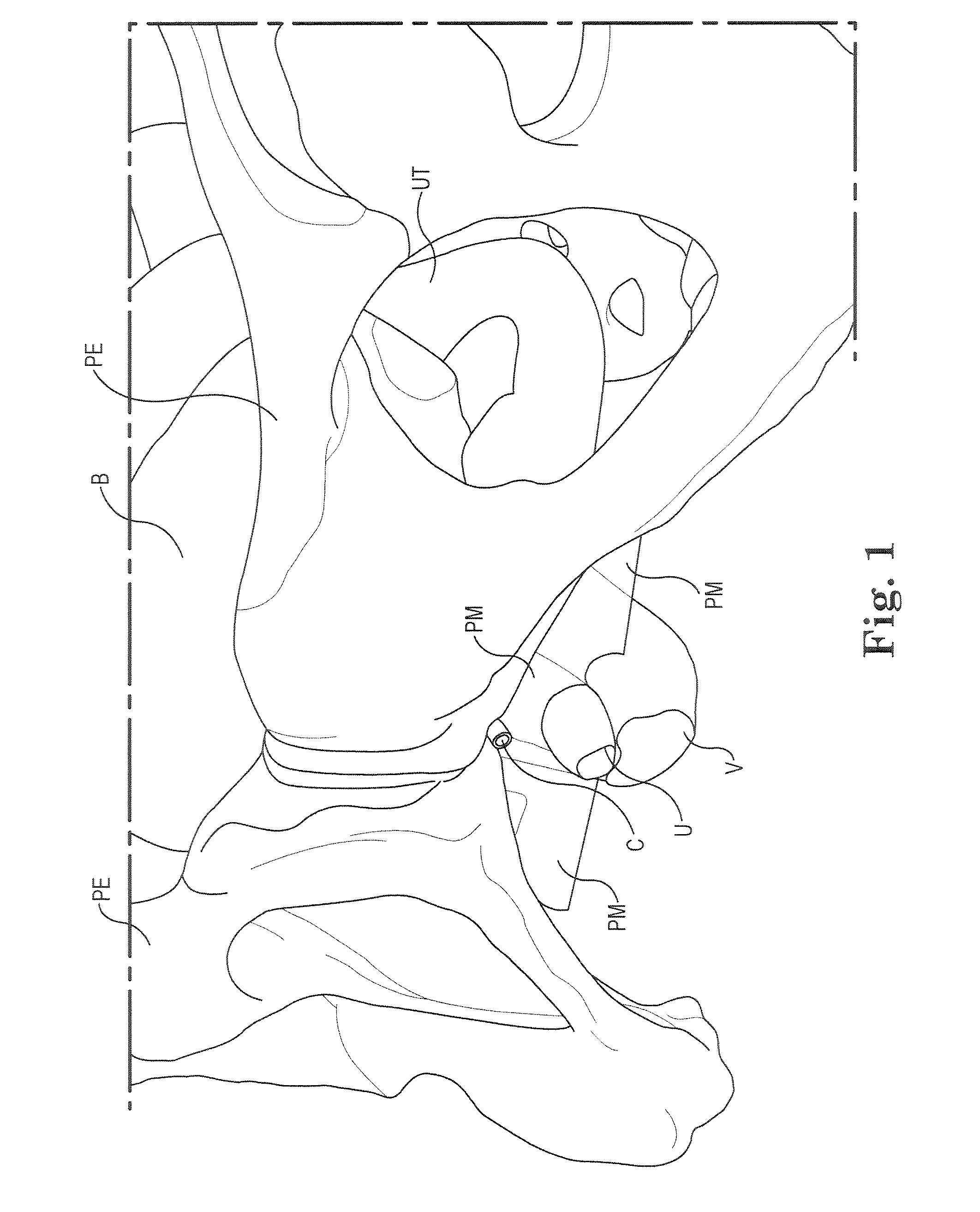 Pelvic Implant System and Method