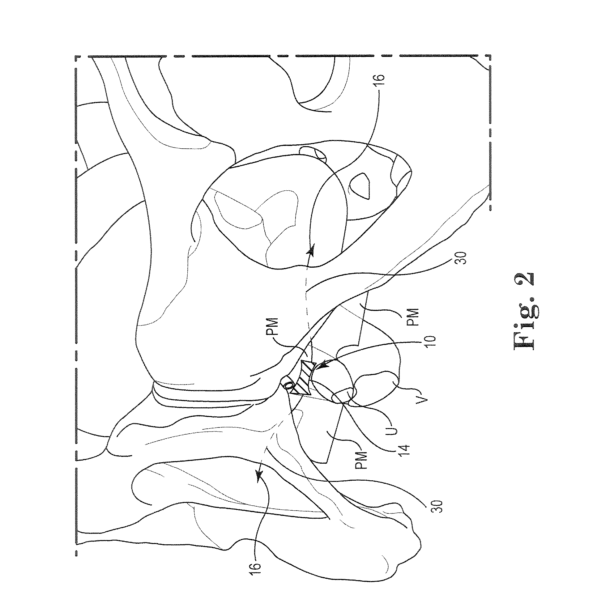 Pelvic Implant System and Method