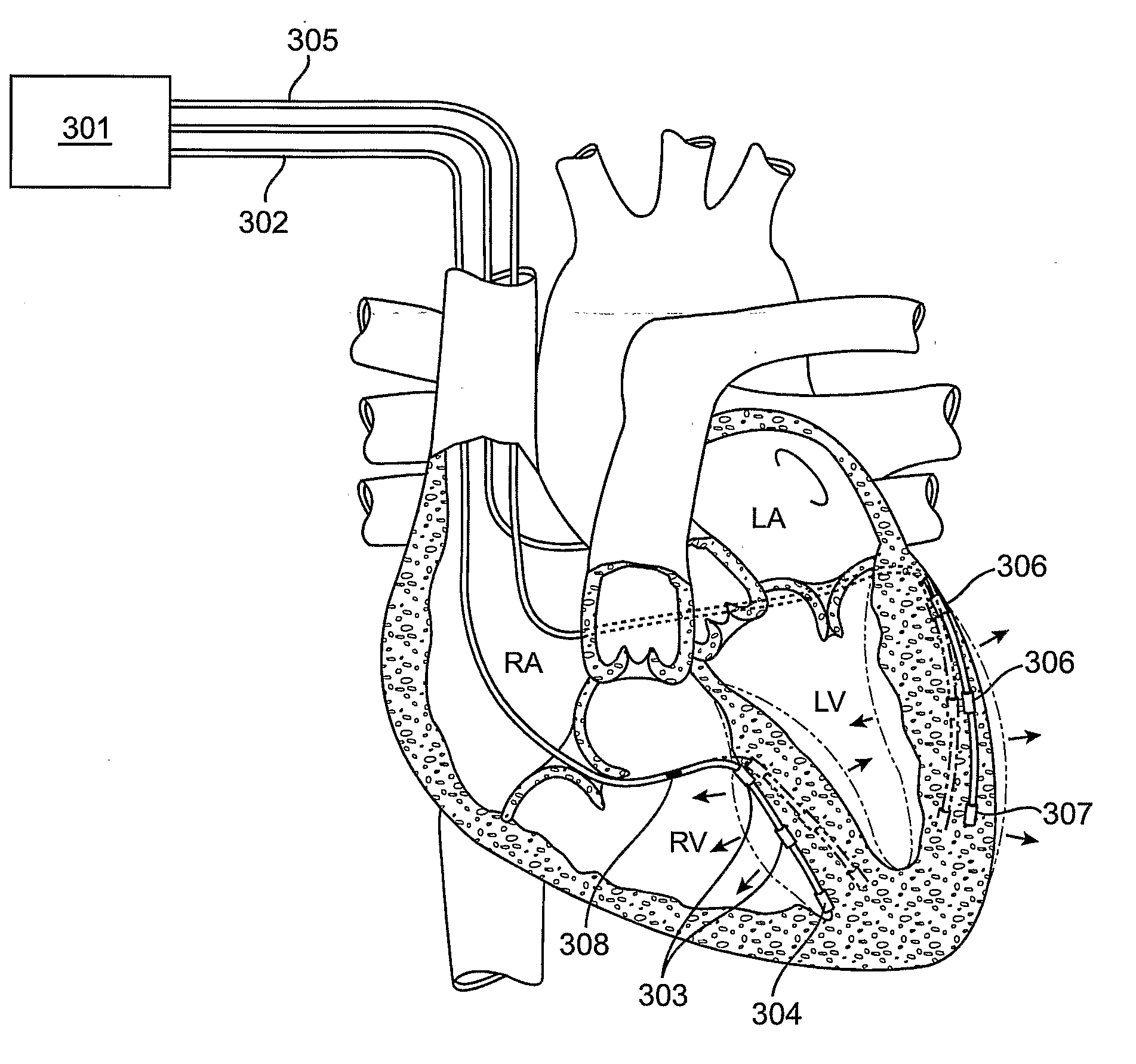 Cardiac Motion Characterization by Strain Measurement