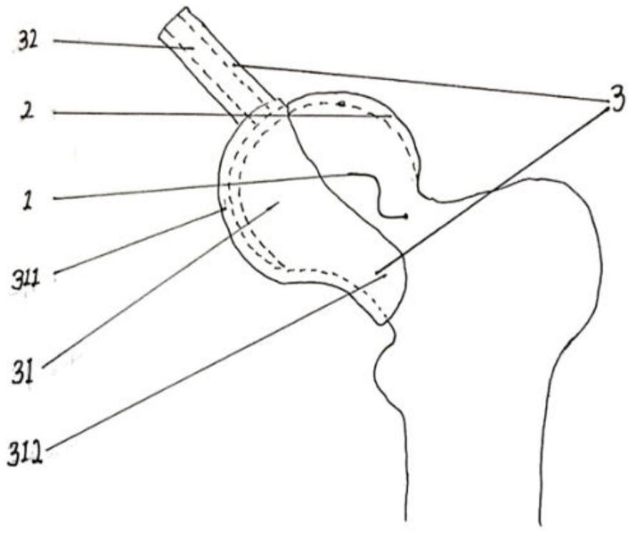 Design method of mask of surgical guide plate taking articular cartilage surface as binding surface