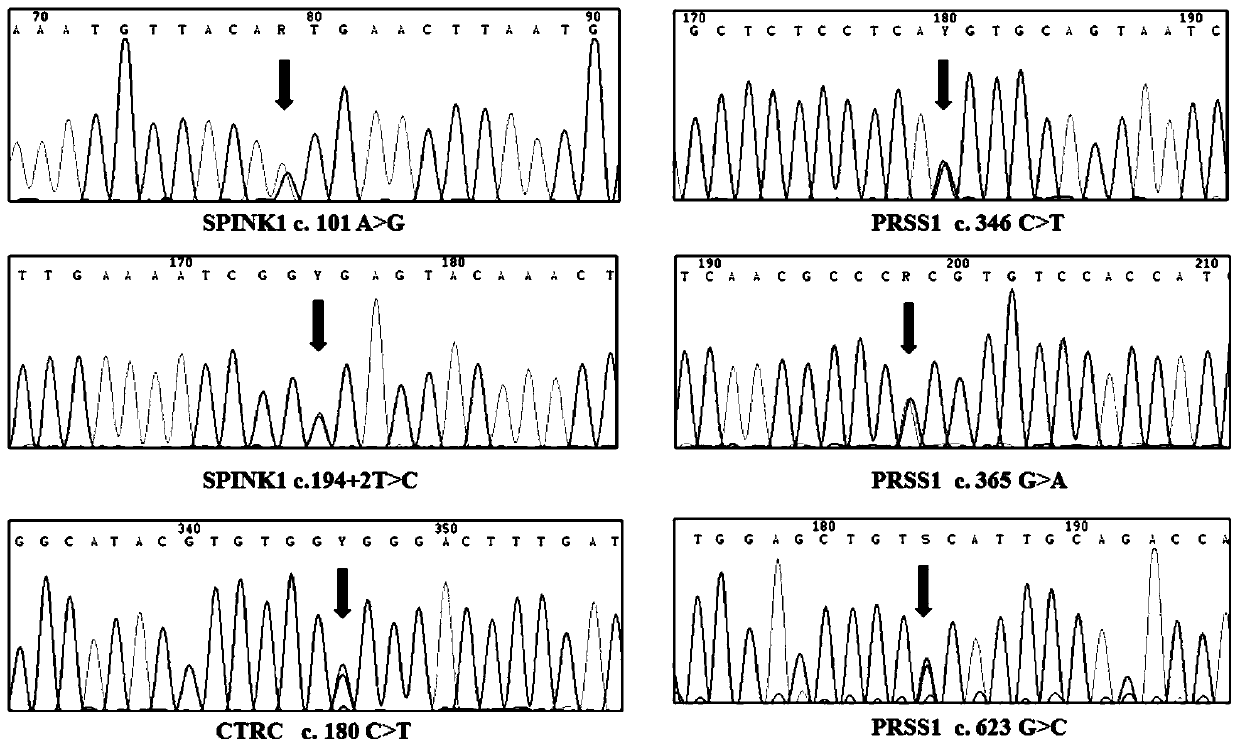 Application of a group of gene mutation sites in the preparation of reagents or kits for diagnosing chronic pancreatitis and evaluating prognosis