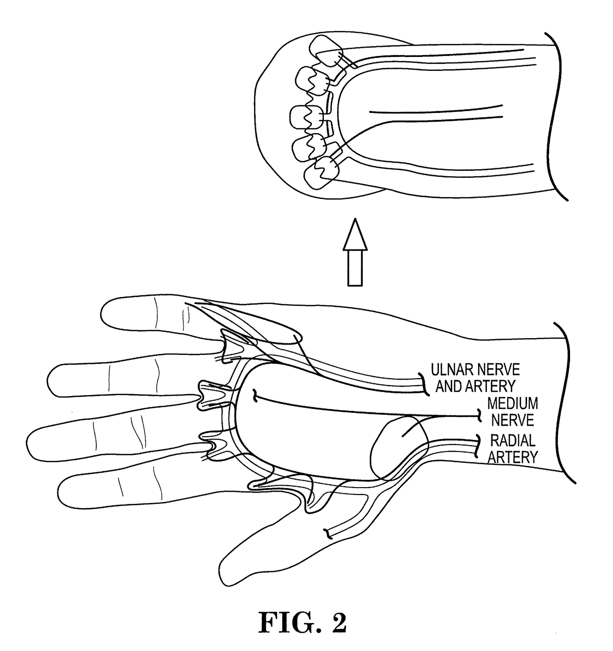 Myoelectric prosthesis and method