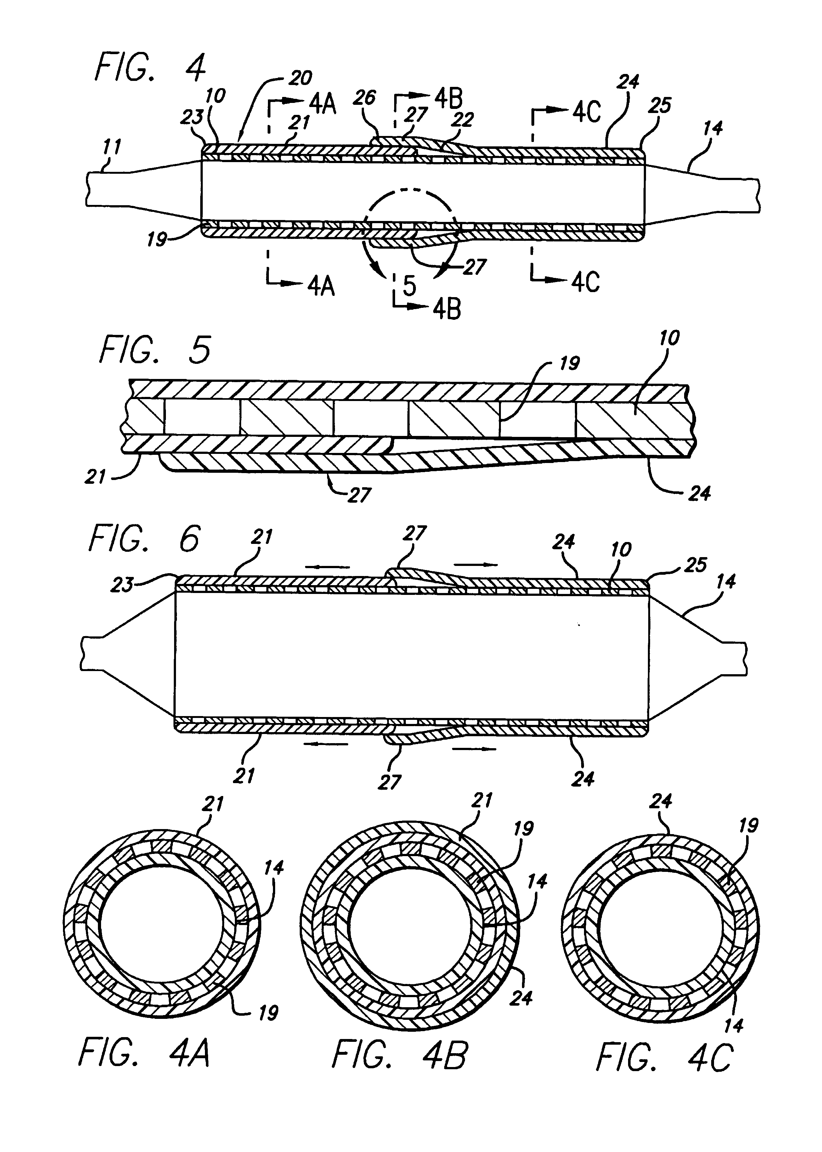 Covered stent assembly for reduced-shortening during stent expansion