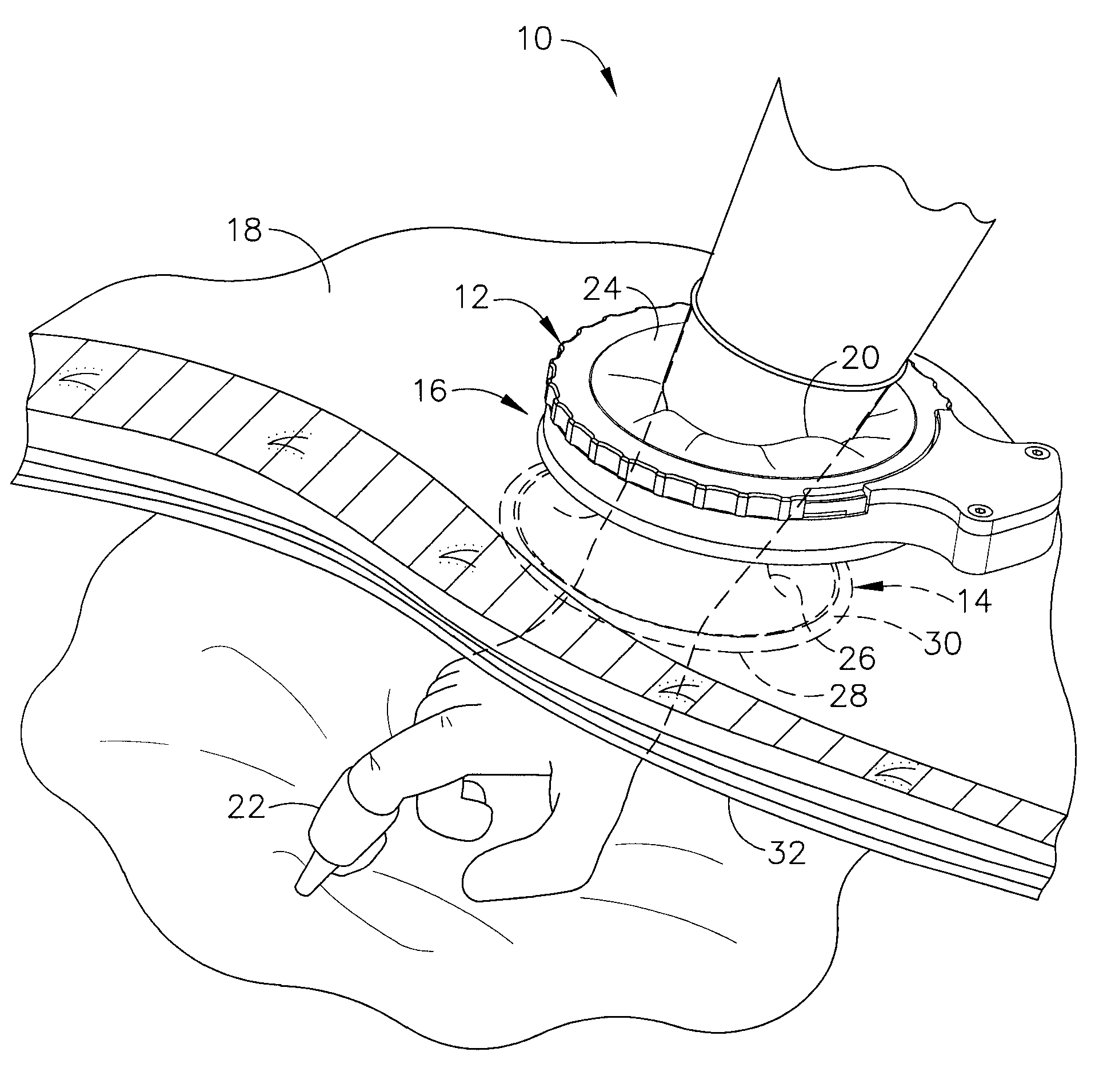 Fully automated iris seal for hand assisted laparoscopic surgical procedures