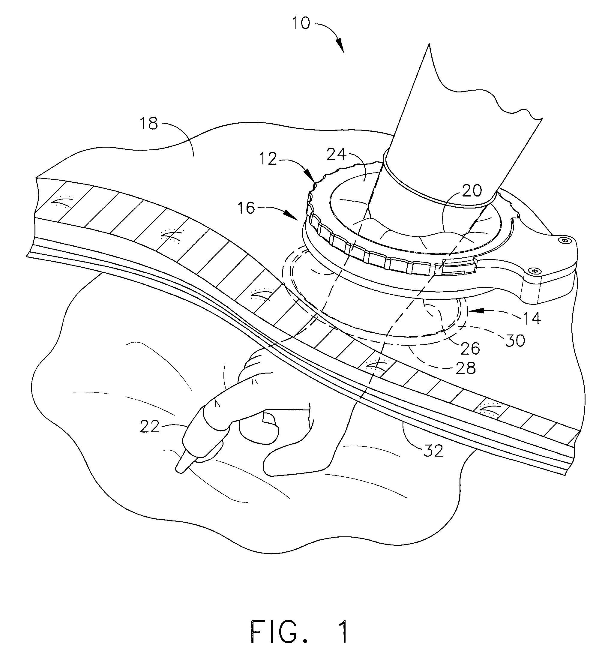 Fully automated iris seal for hand assisted laparoscopic surgical procedures