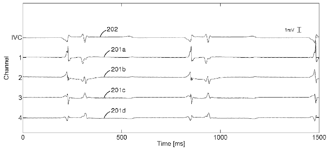 System and method for processing signals from intracardiac catheters