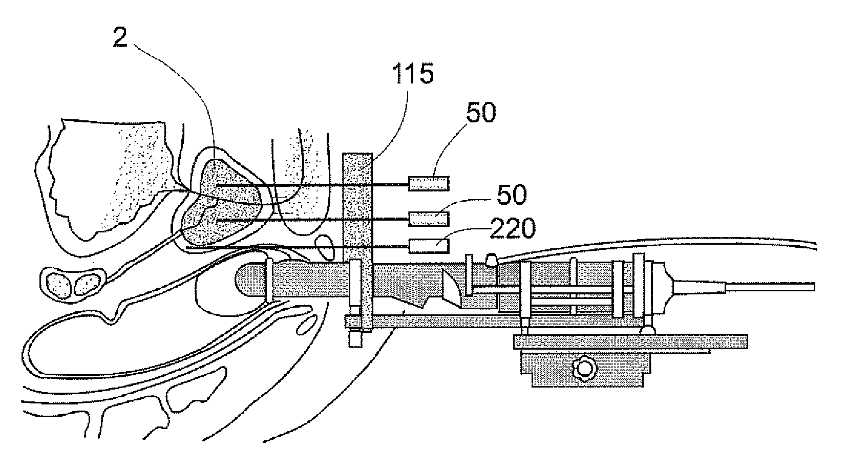 Apparatus and method for protecting tissues during cryoablation