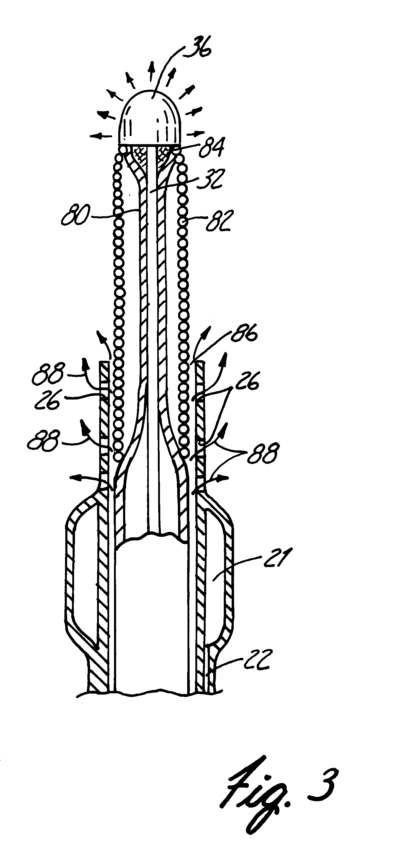 Apparatus and method for treatment of cerebral aneurysms, arterial-vascular malformations and arterial fistulas