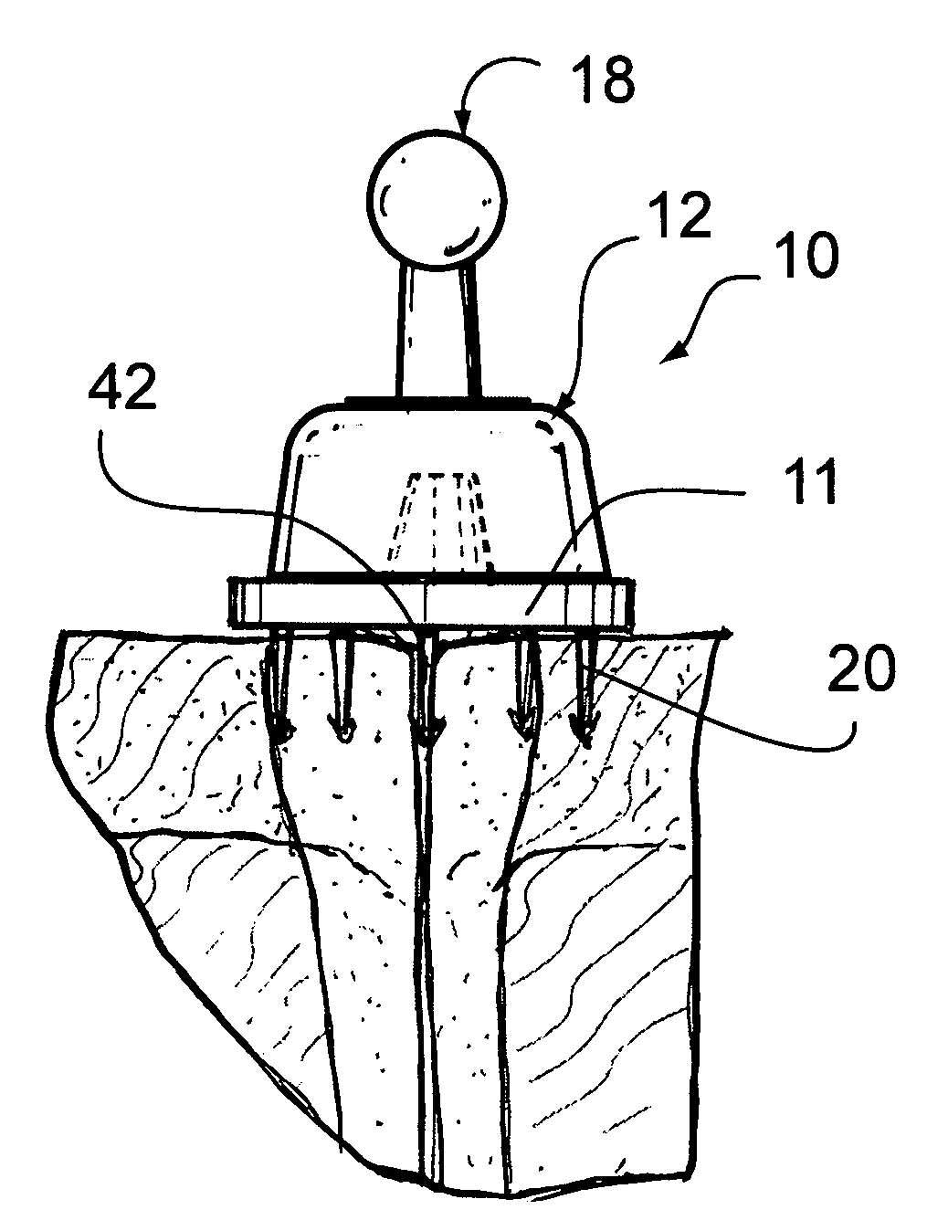 Apparatus and method for preventing fluid transfer between an oviduct and a uterine cavity