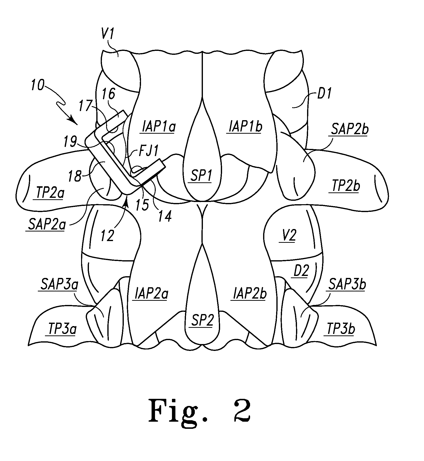 Spinal facet fastener