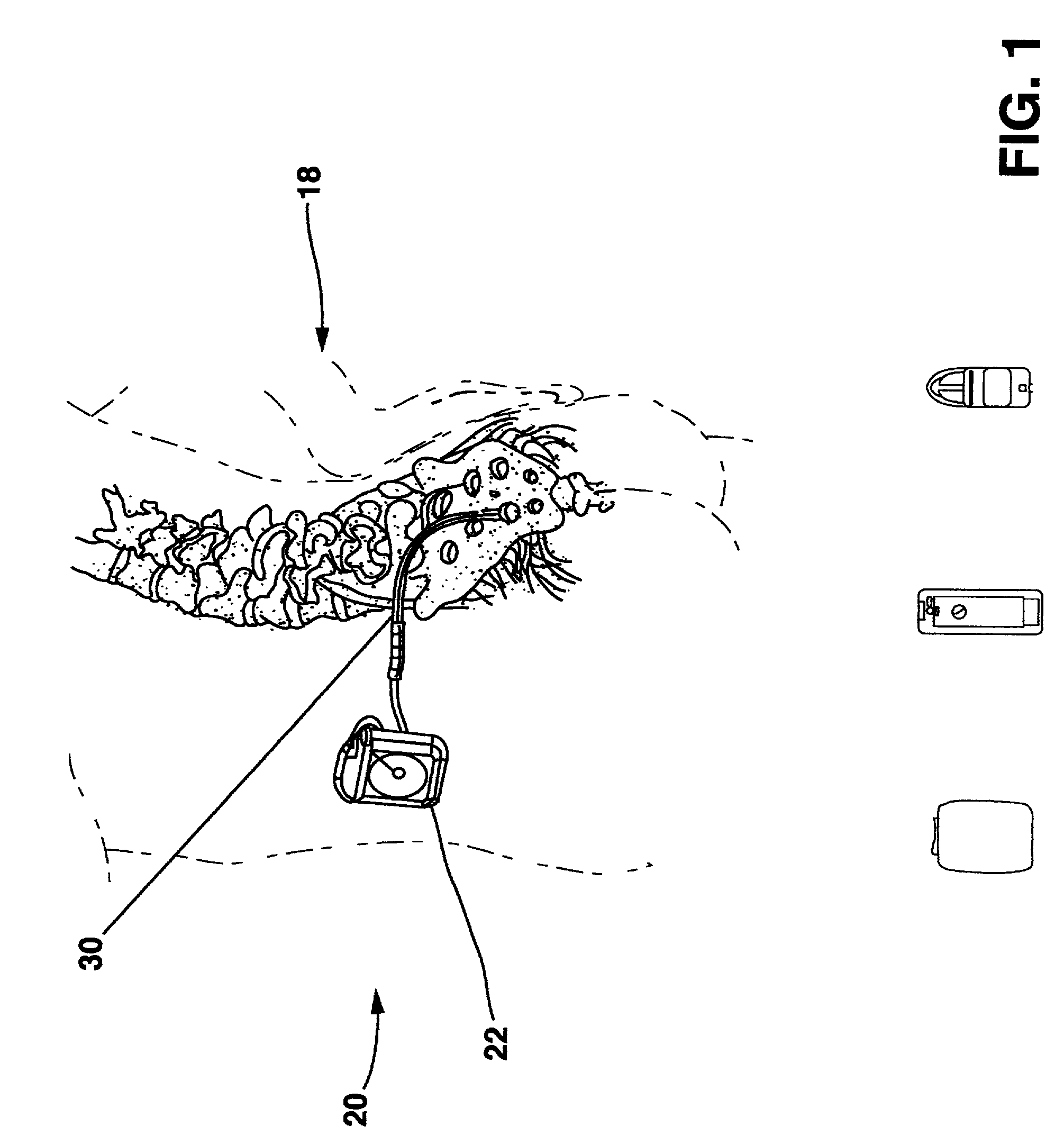 Implantable lead with isolated contact coupling