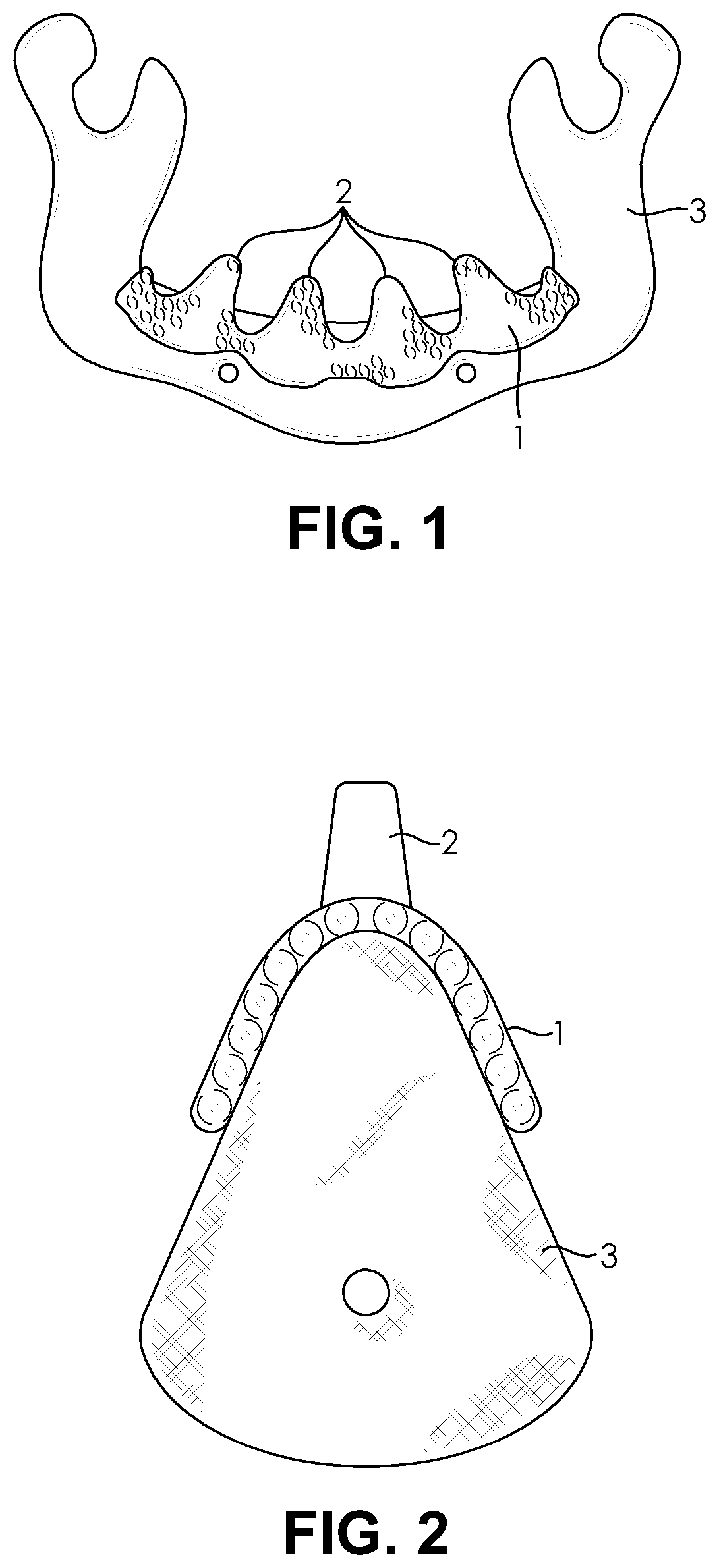 Customized porous supracrestal implant and materials and methods forming them