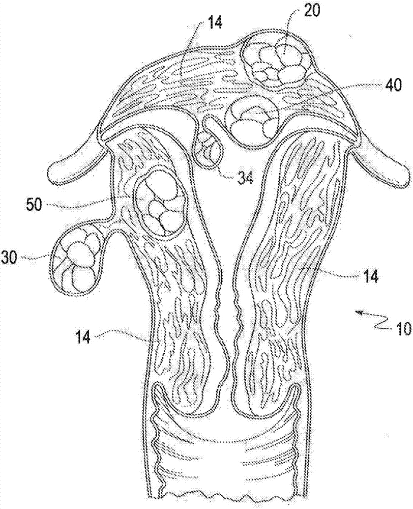 Electrosurgical fibroid ablation systems and methods