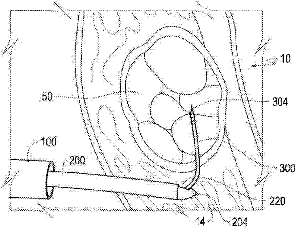 Electrosurgical fibroid ablation systems and methods