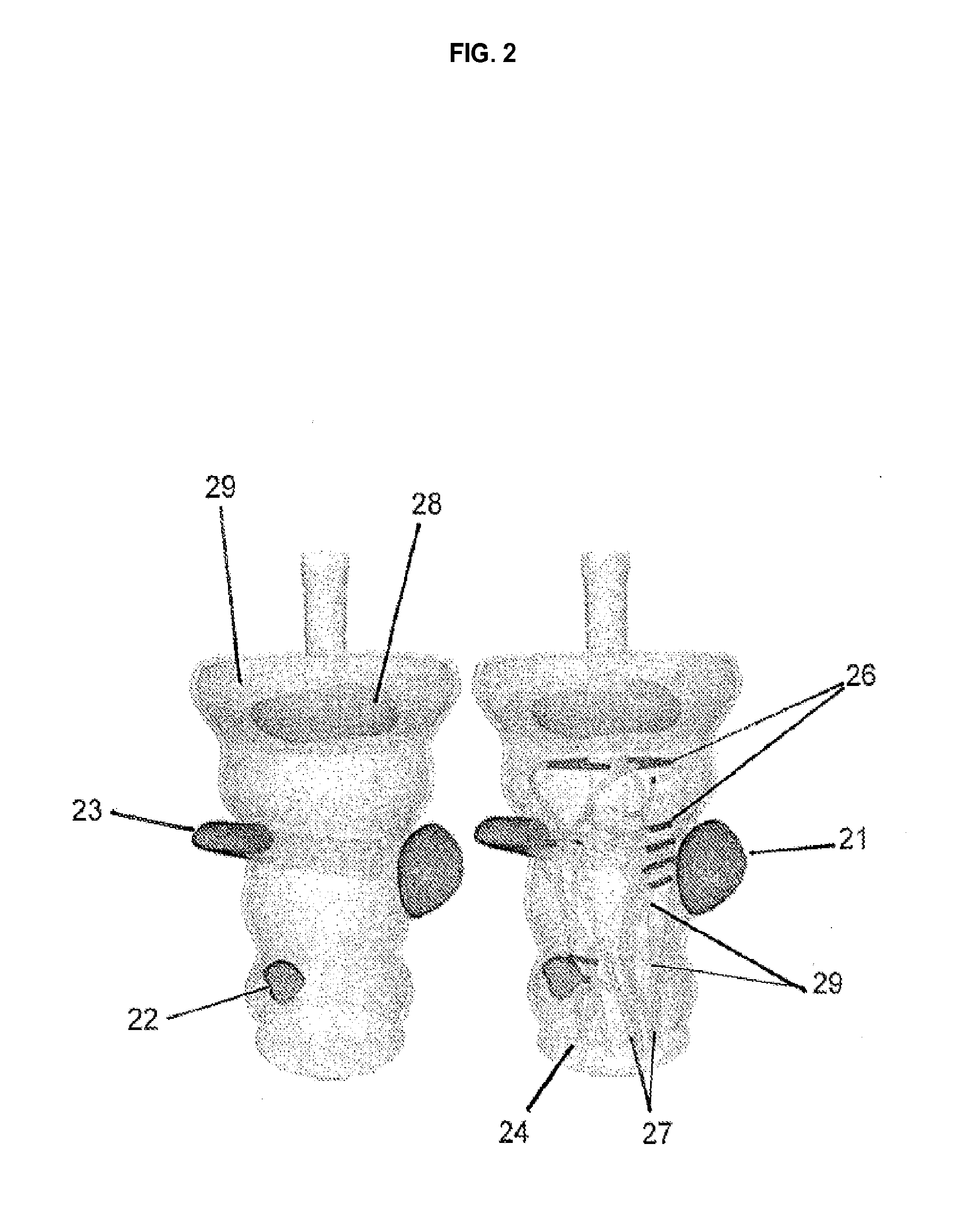 Patient-specific temporary implants for accurately guiding local means of tumor control along patient-specific internal channels to treat cancer