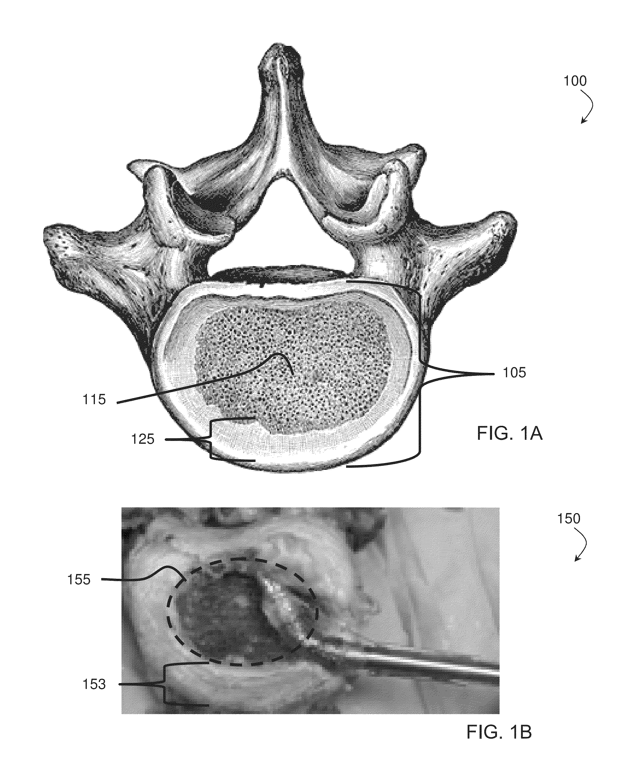 Staged, bilaterally expandable trial