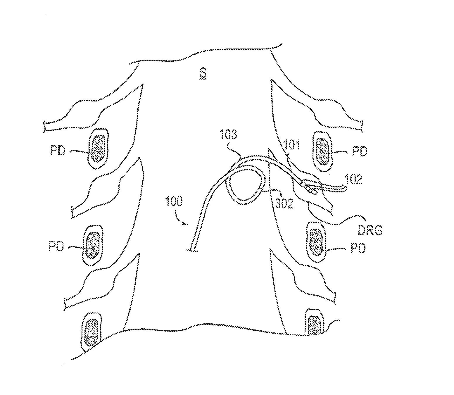 Methods, systems and devices for reducing migration