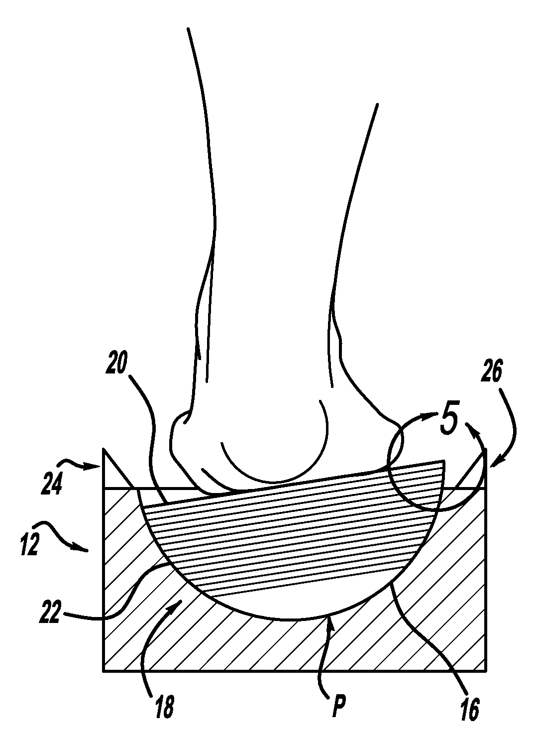 Measurement system for varus/valgus angles in feet