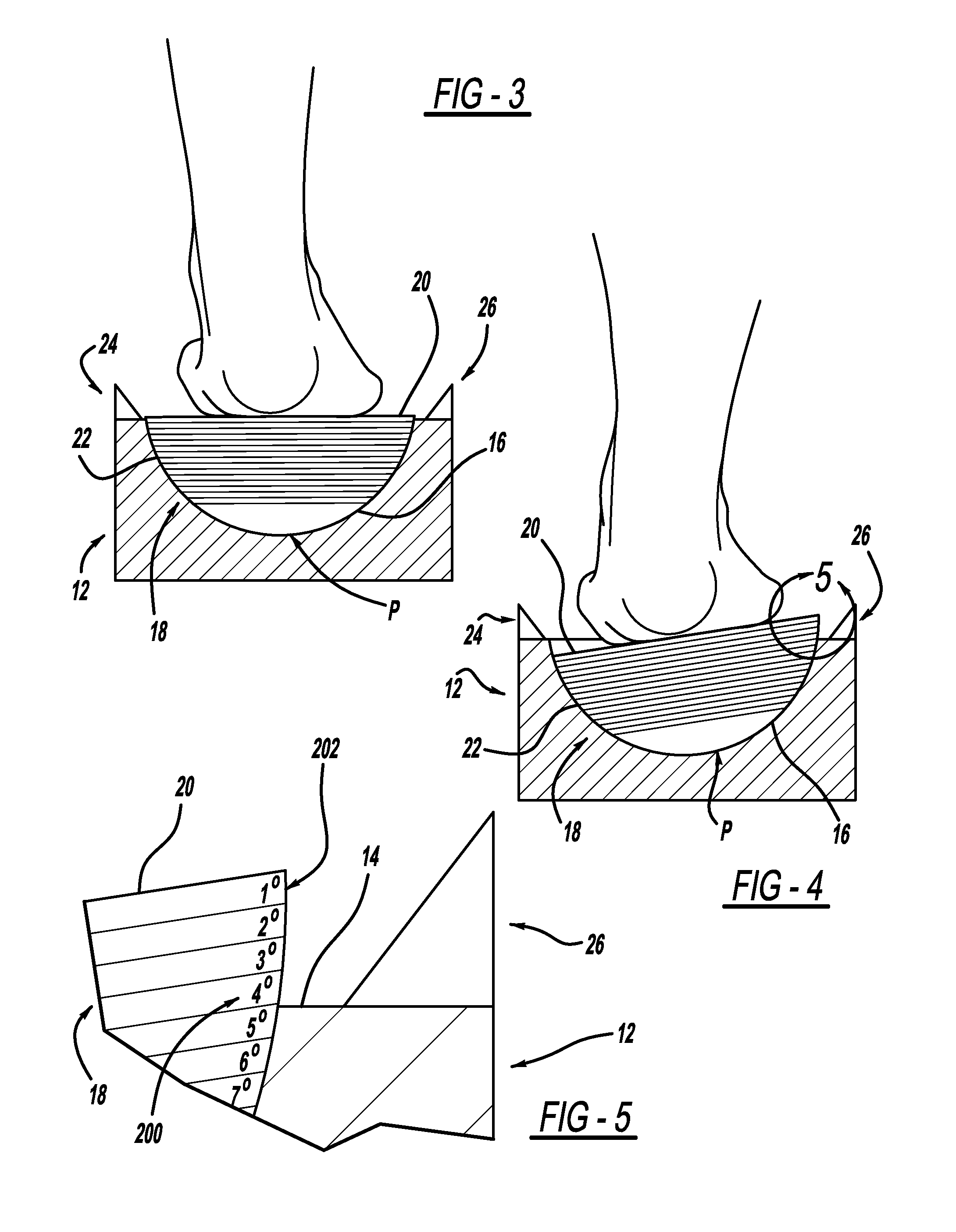 Measurement system for varus/valgus angles in feet