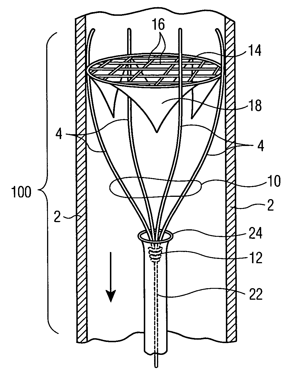 Method of treatment and devices for the treatment of left ventricular failure