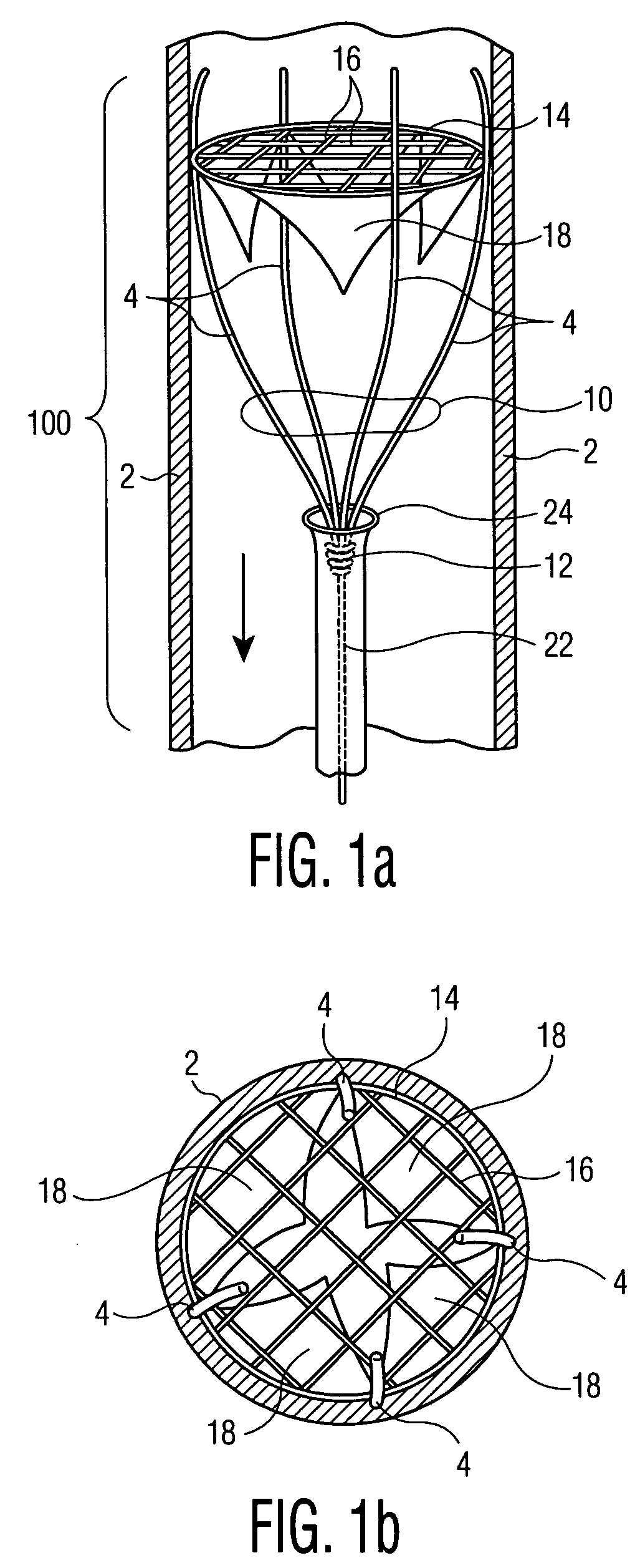 Method of treatment and devices for the treatment of left ventricular failure