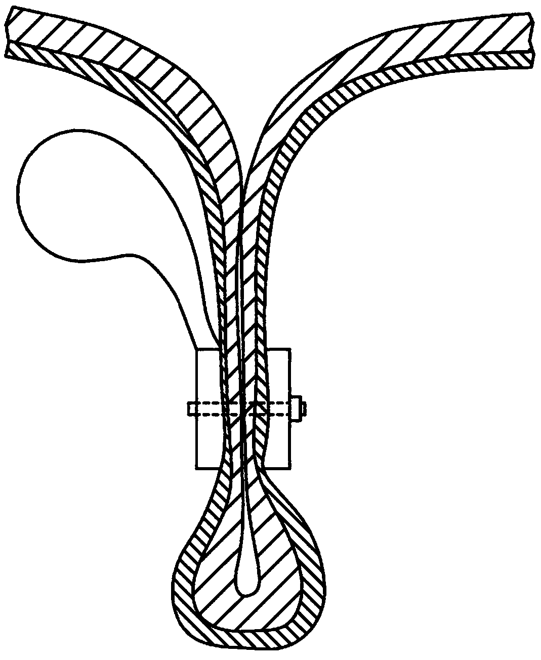 Endolumenal esophageal restriction device